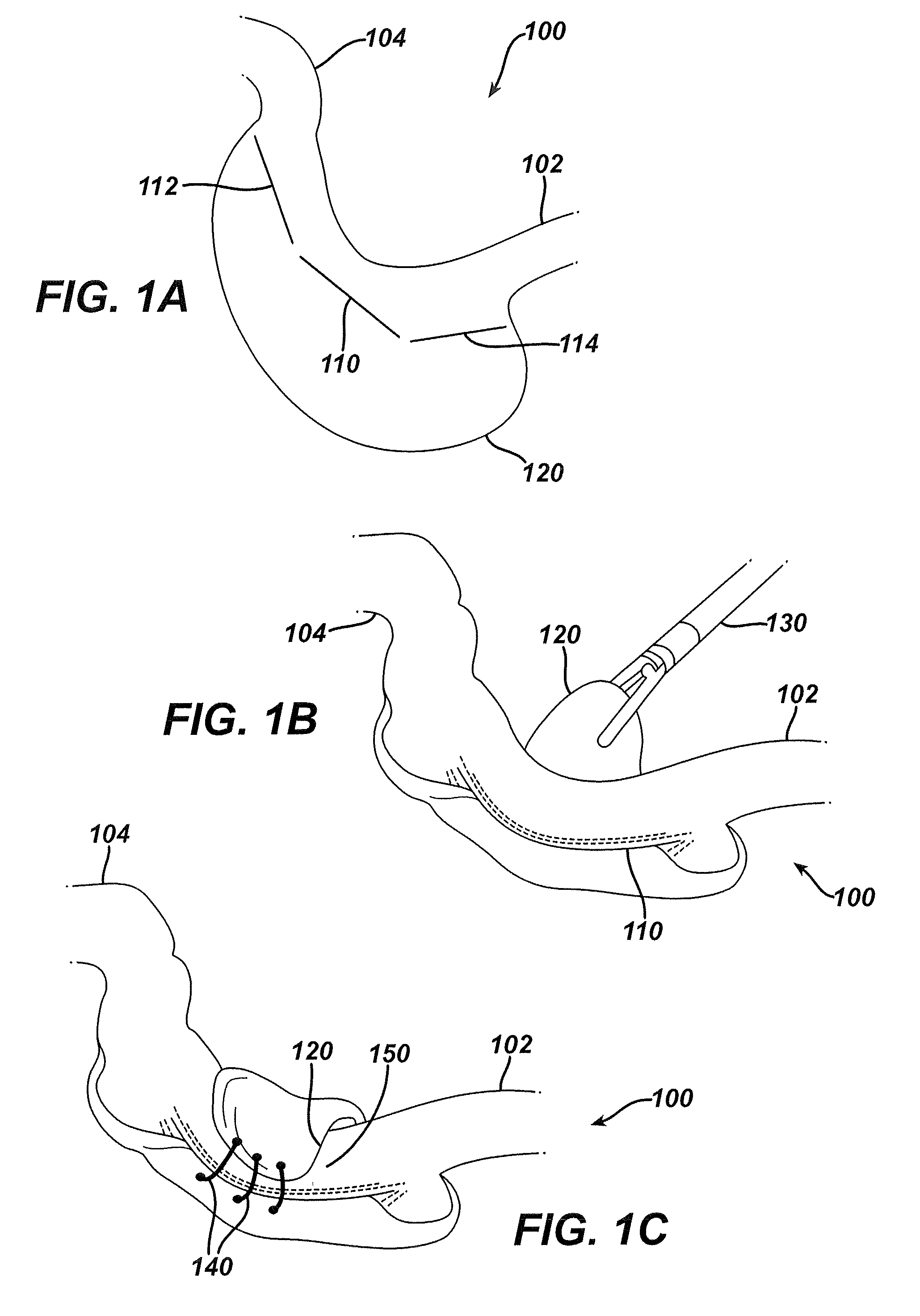 Systems and methods for gastric volume regulation