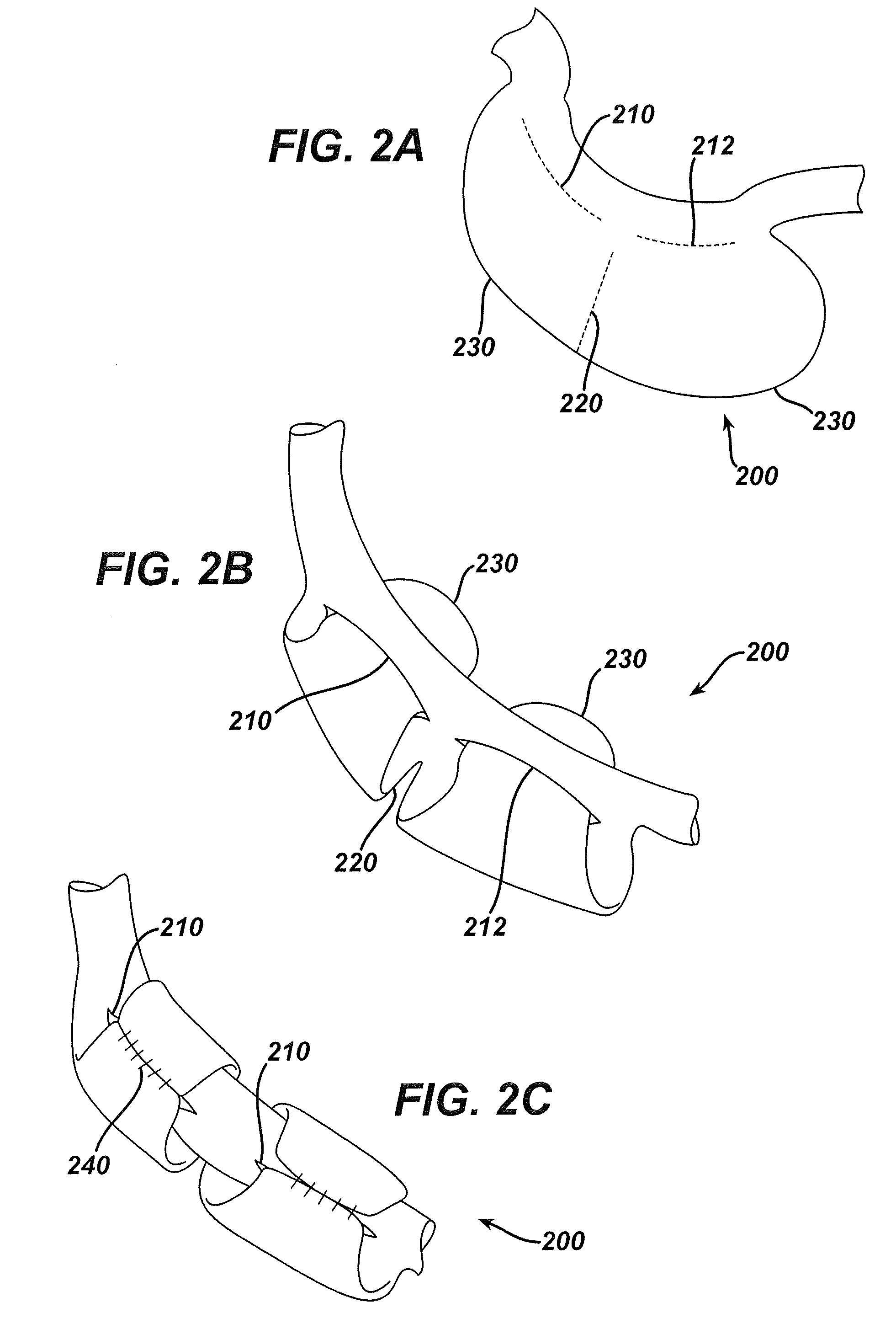 Systems and methods for gastric volume regulation