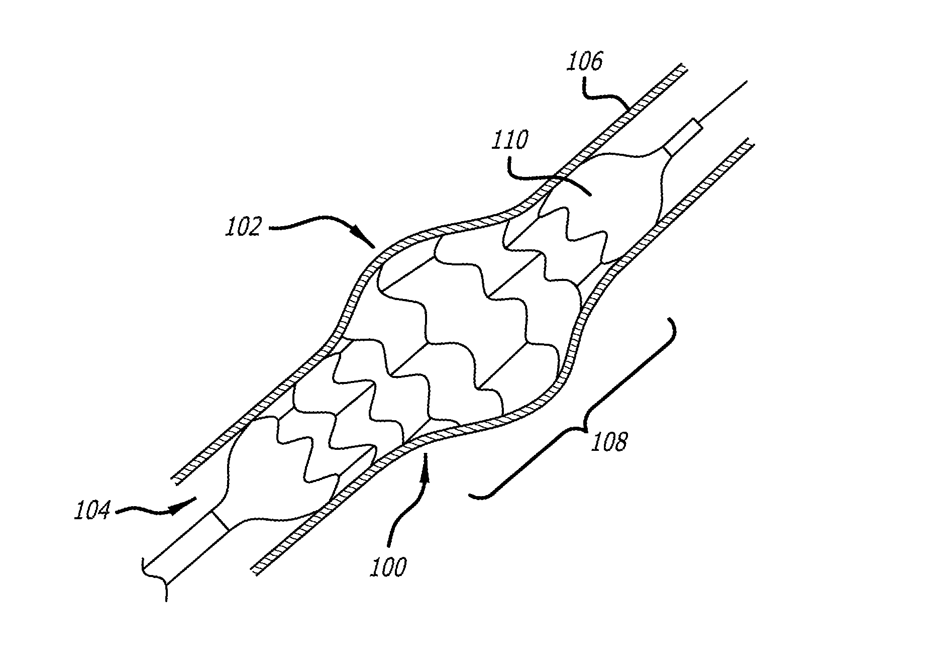 Method of fabricating an intraluminal scaffold with an enlarged portion