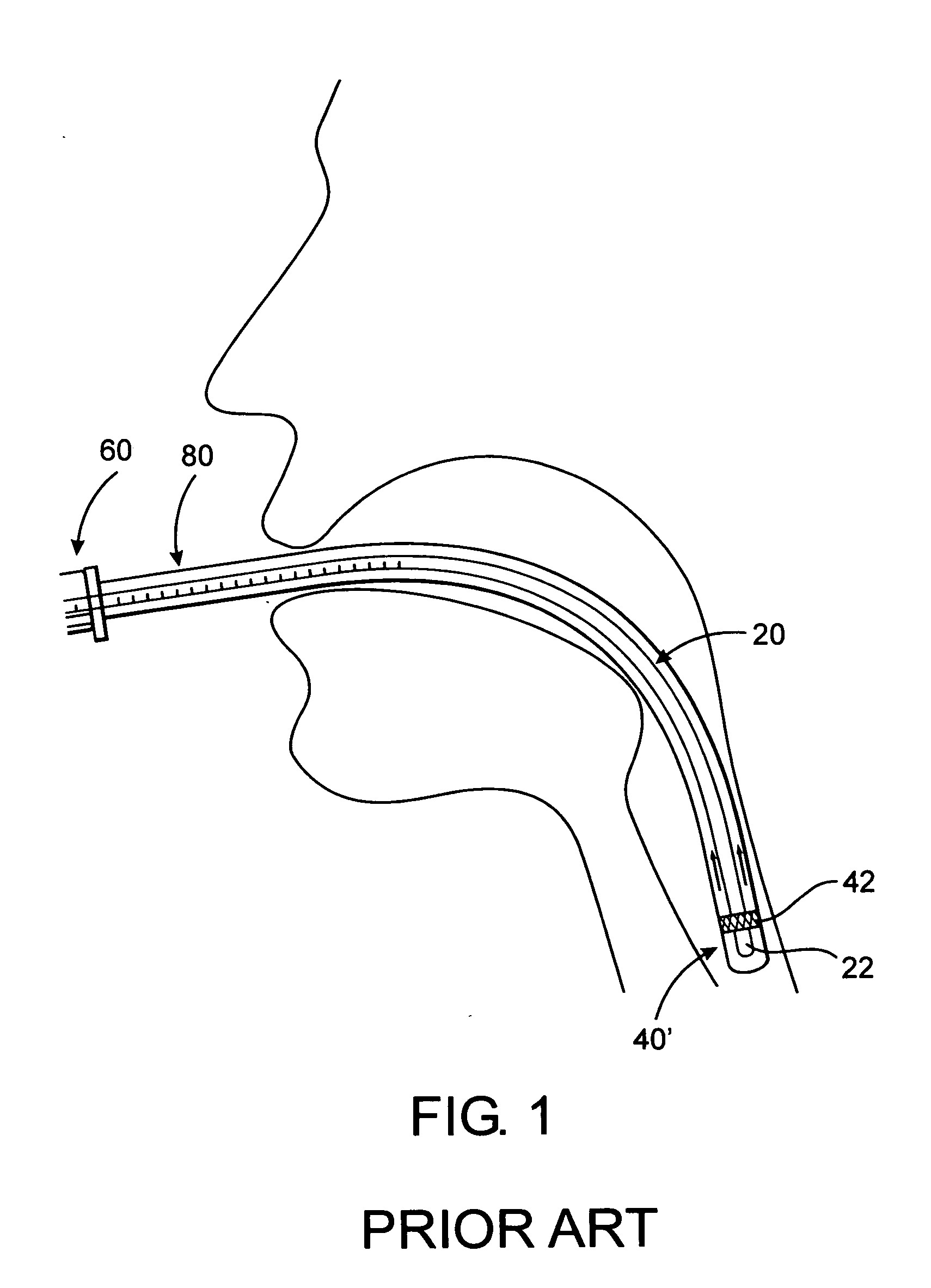 Cleaning assembly for an endotracheal tube