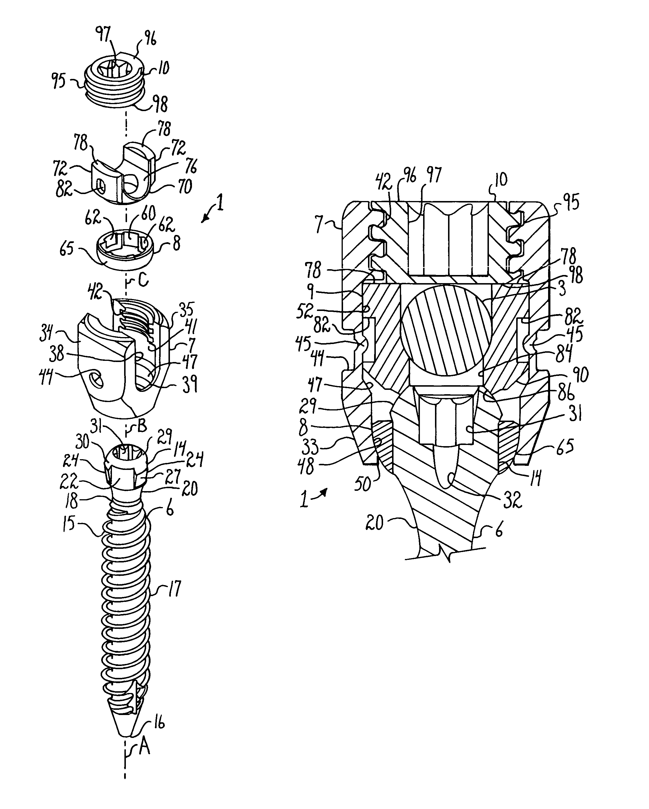 Polyaxial bone anchor with spline capture connection and lower pressure insert