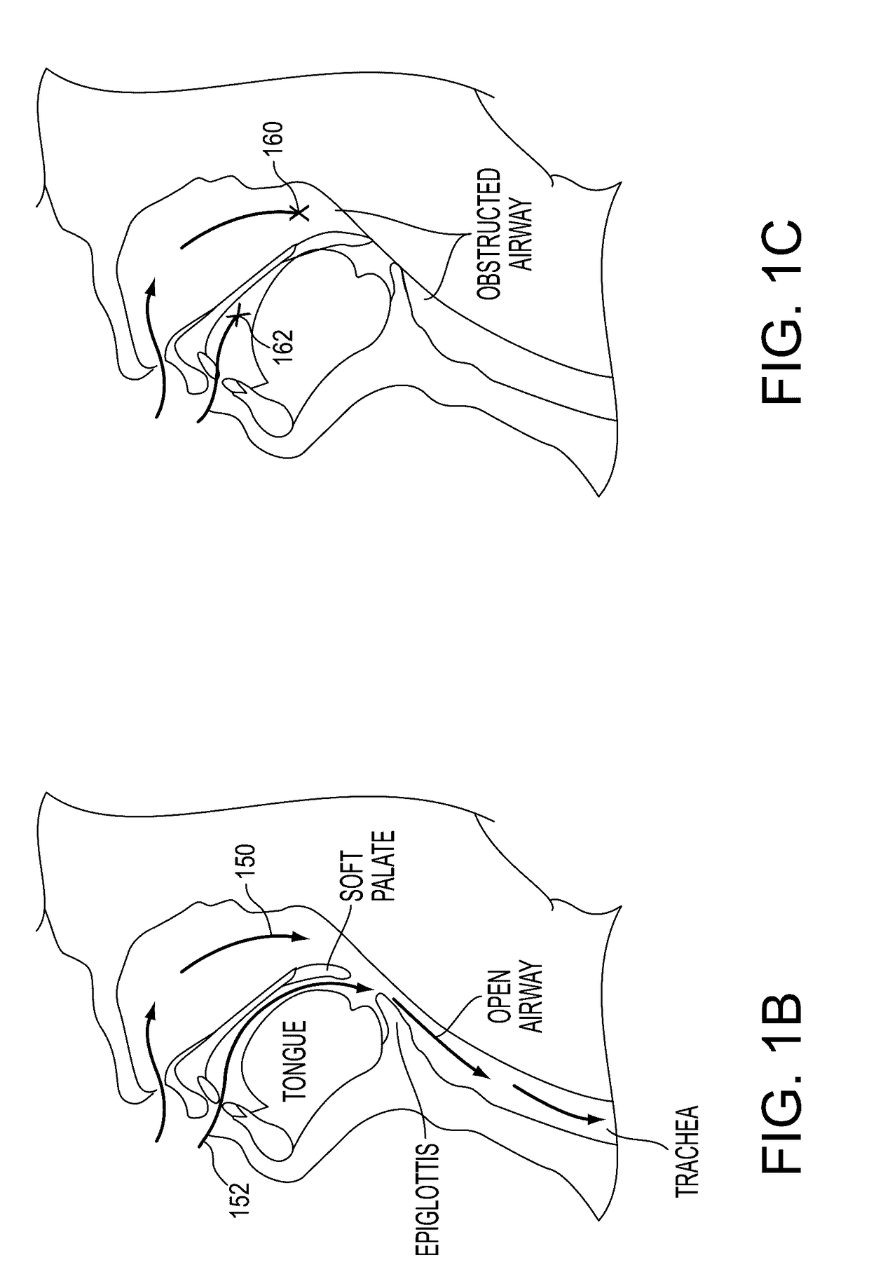 Systems, methods and devices for diagnosing sleep apnea