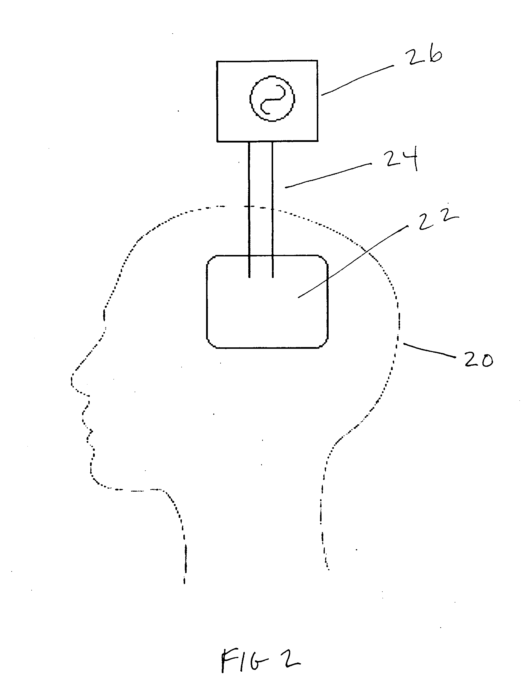 Method and devices for treatment of neurological stroke