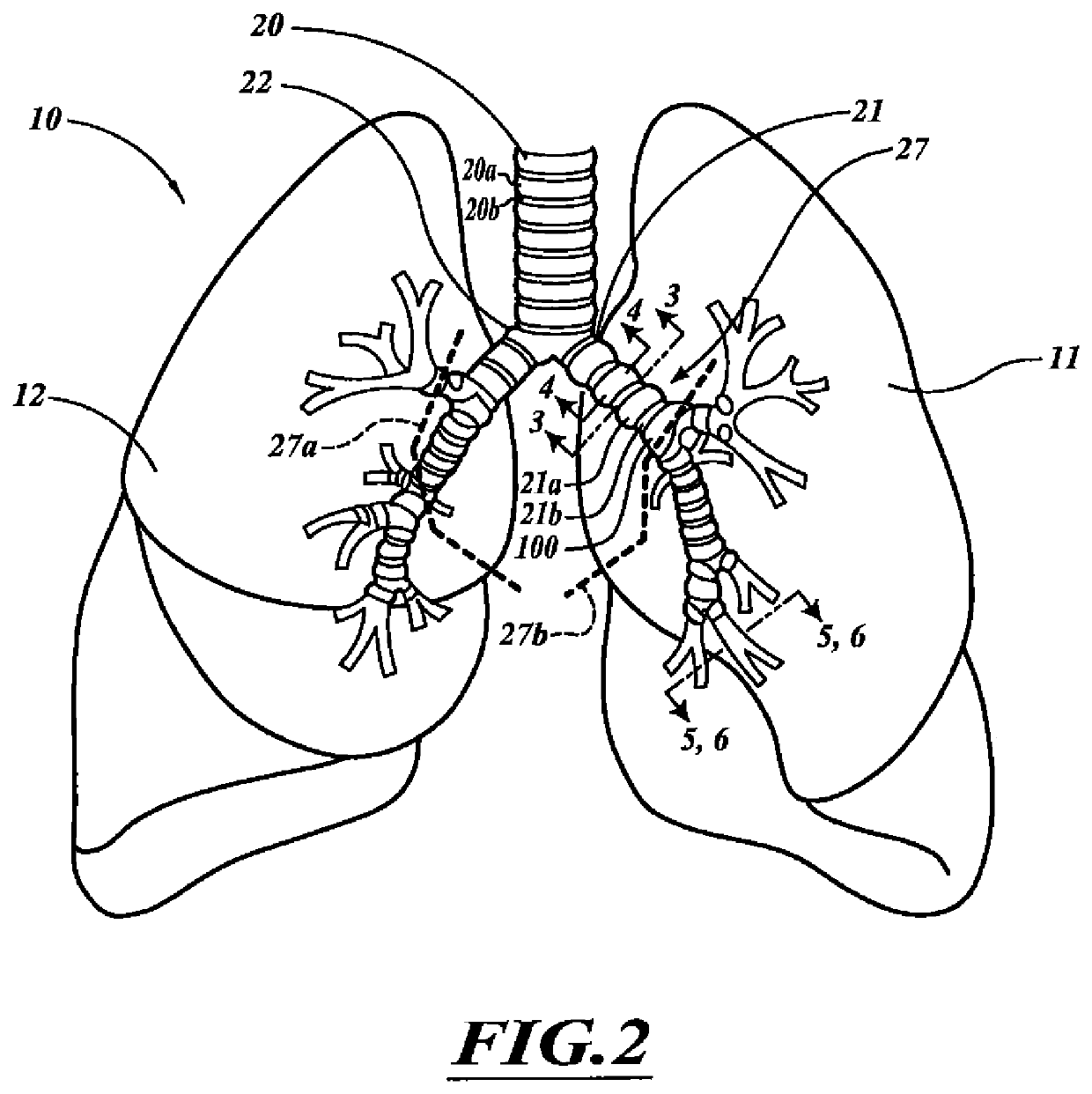 Systems, devices, and methods for treating a pulmonary disorder with an agent