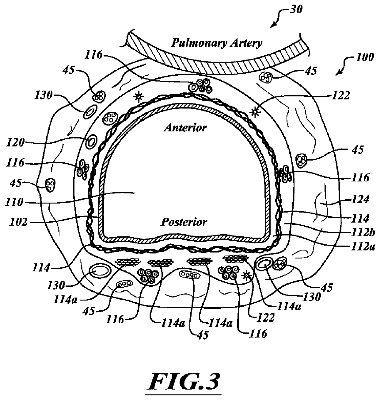 Systems, devices, and methods for treating a pulmonary disorder with an agent