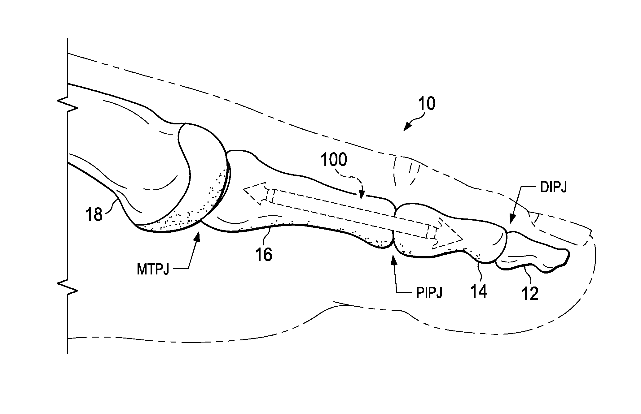 Methods and Implants for Treating Hammertoe and Other Deformities