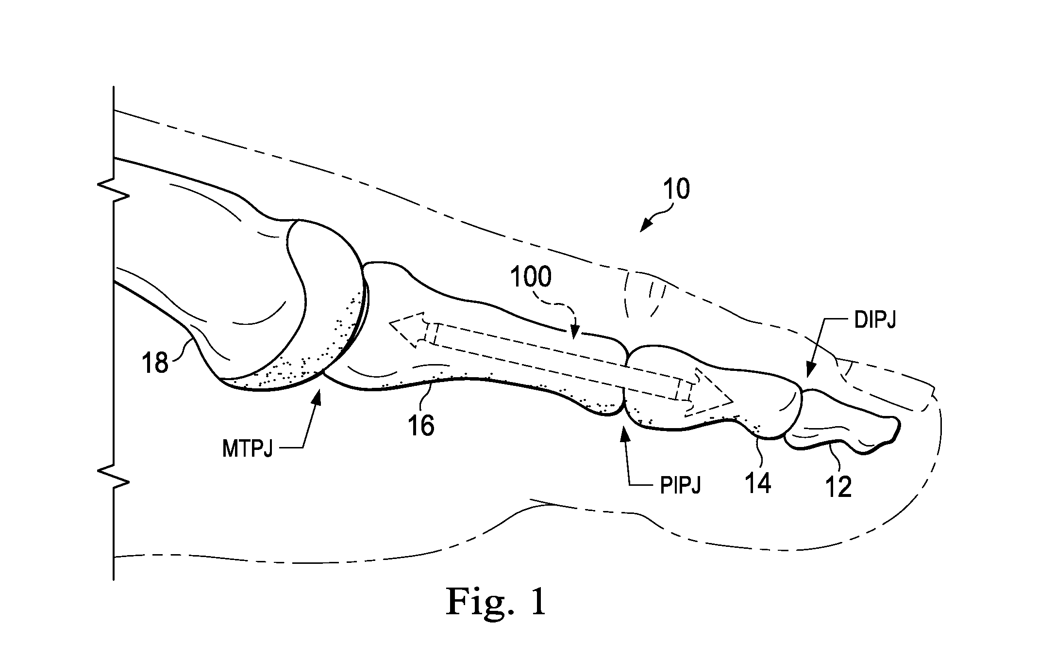Methods and Implants for Treating Hammertoe and Other Deformities