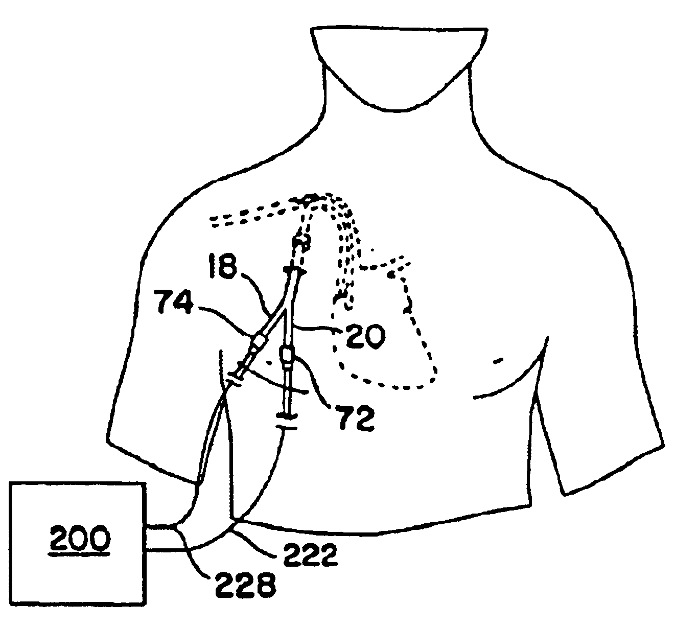 Double-y-shaped multi-lumen catheter with selectively attachable hubs