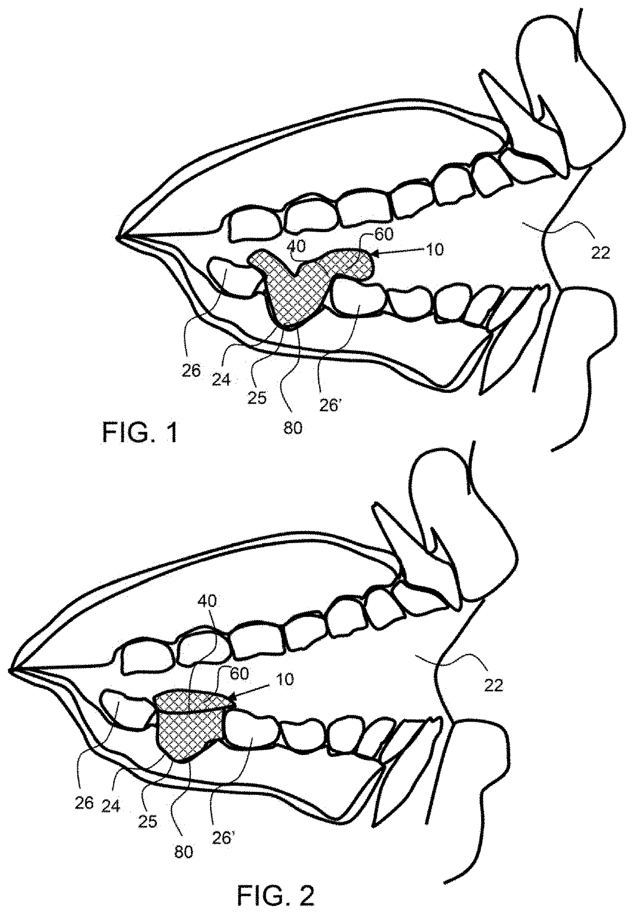 Method of oral hemostasis using a conformable non-disruptive hemostasis material