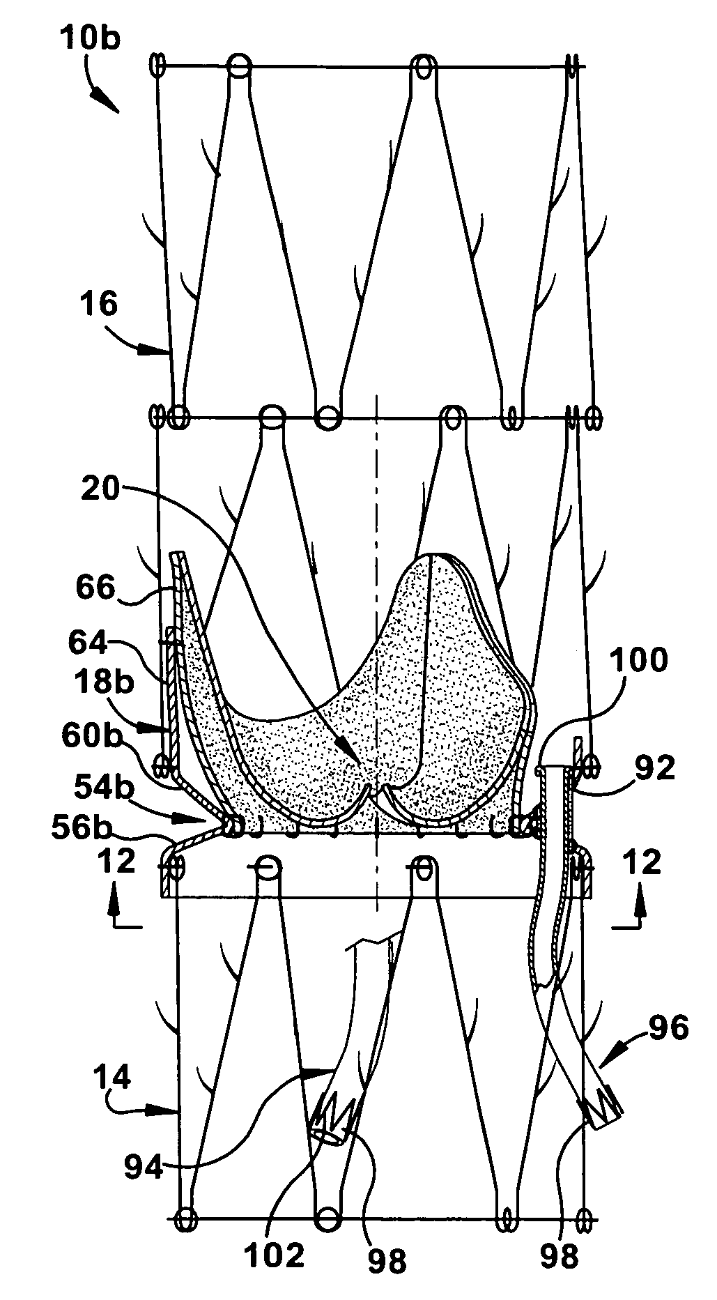 Apparatus and methods for repairing the function of a diseased valve and method for making same