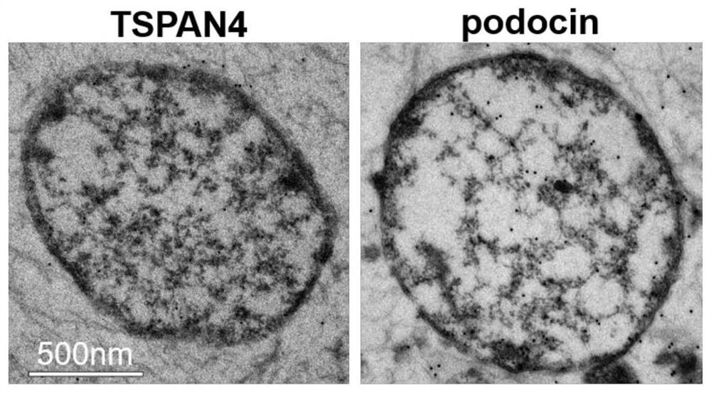 Application of urine podocyte-derived migration body in predicting early injury of glomerular podocytes