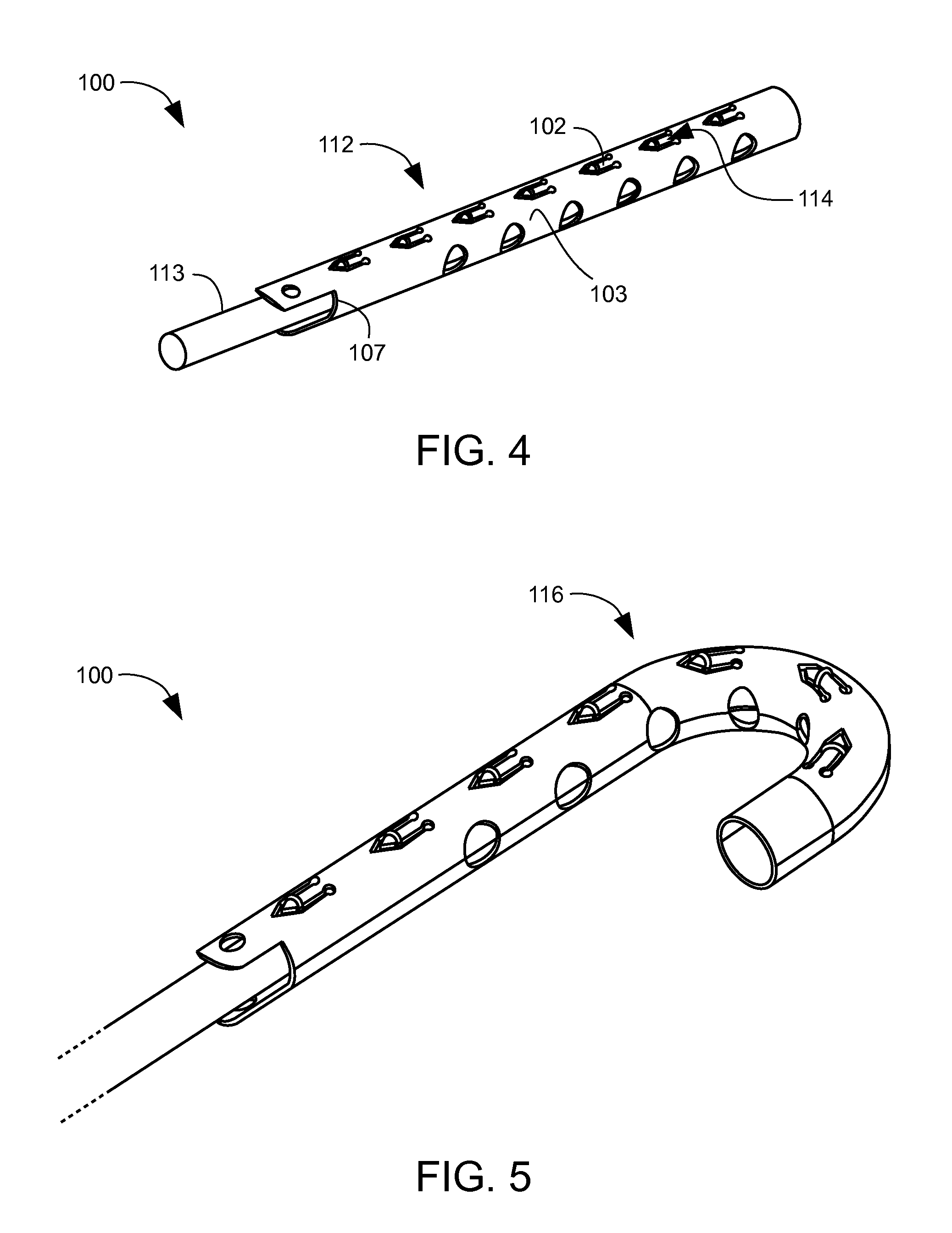 Memory material implant system and methods of use