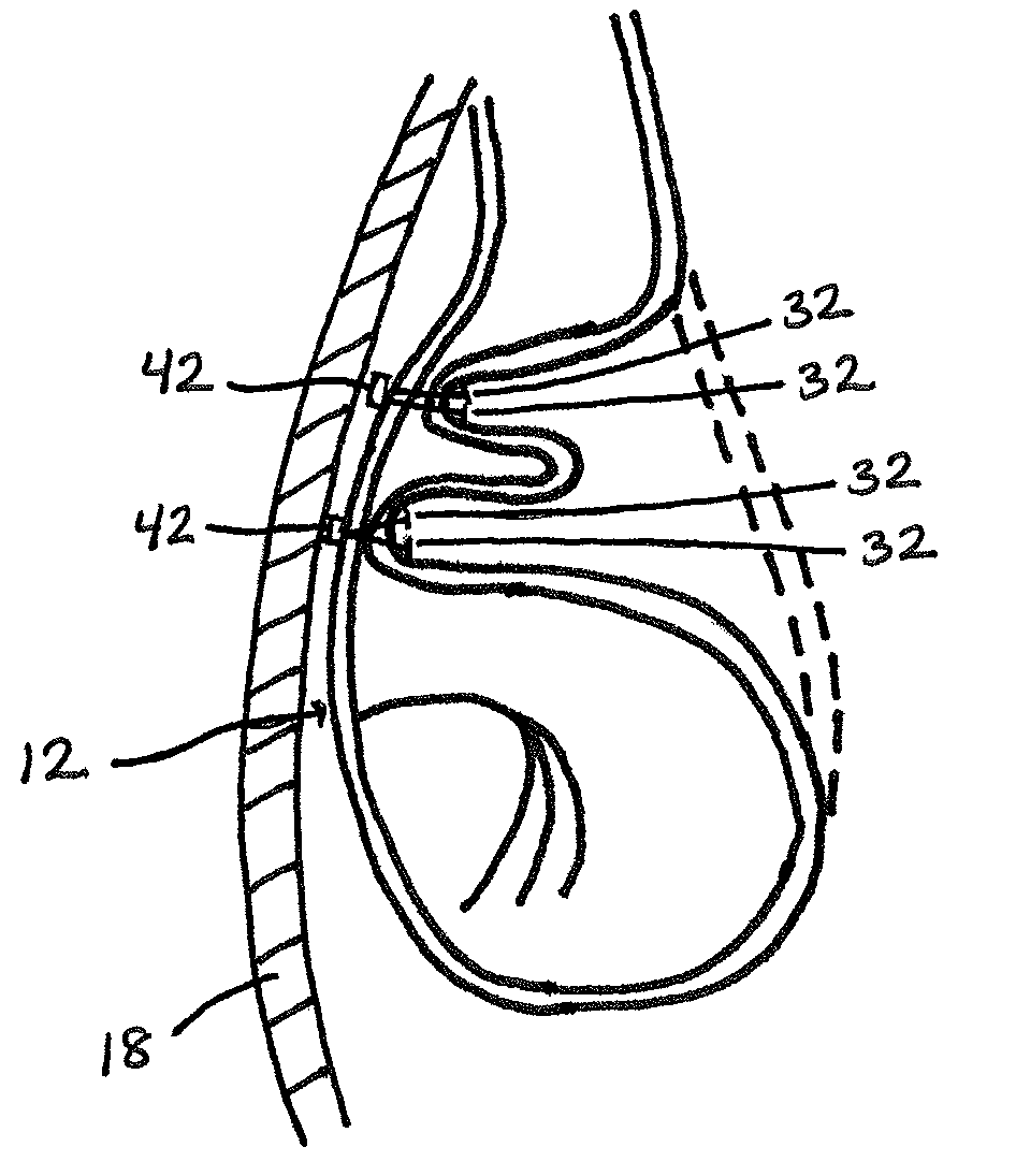 Gastric volume reduction using anterior to posterior wall junctions
