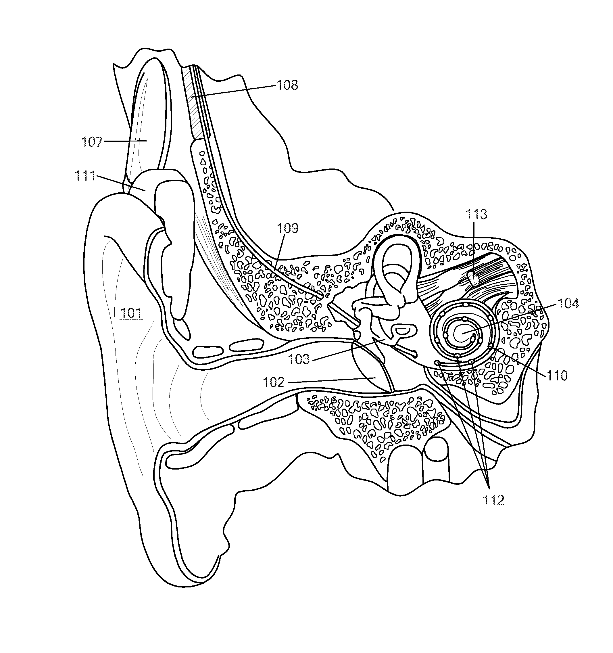 Ear Implant Electrode and Method of Manufacture