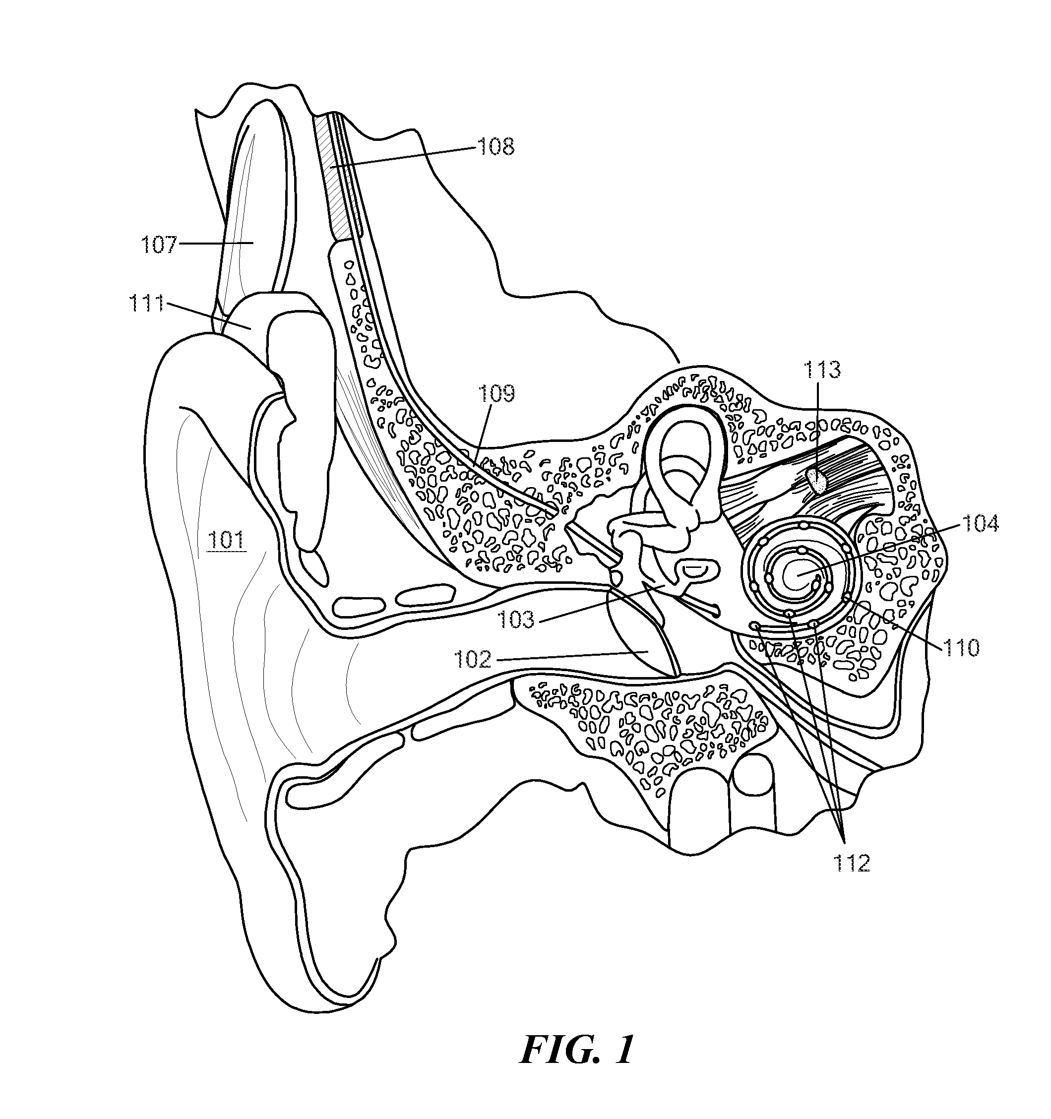 Ear Implant Electrode and Method of Manufacture