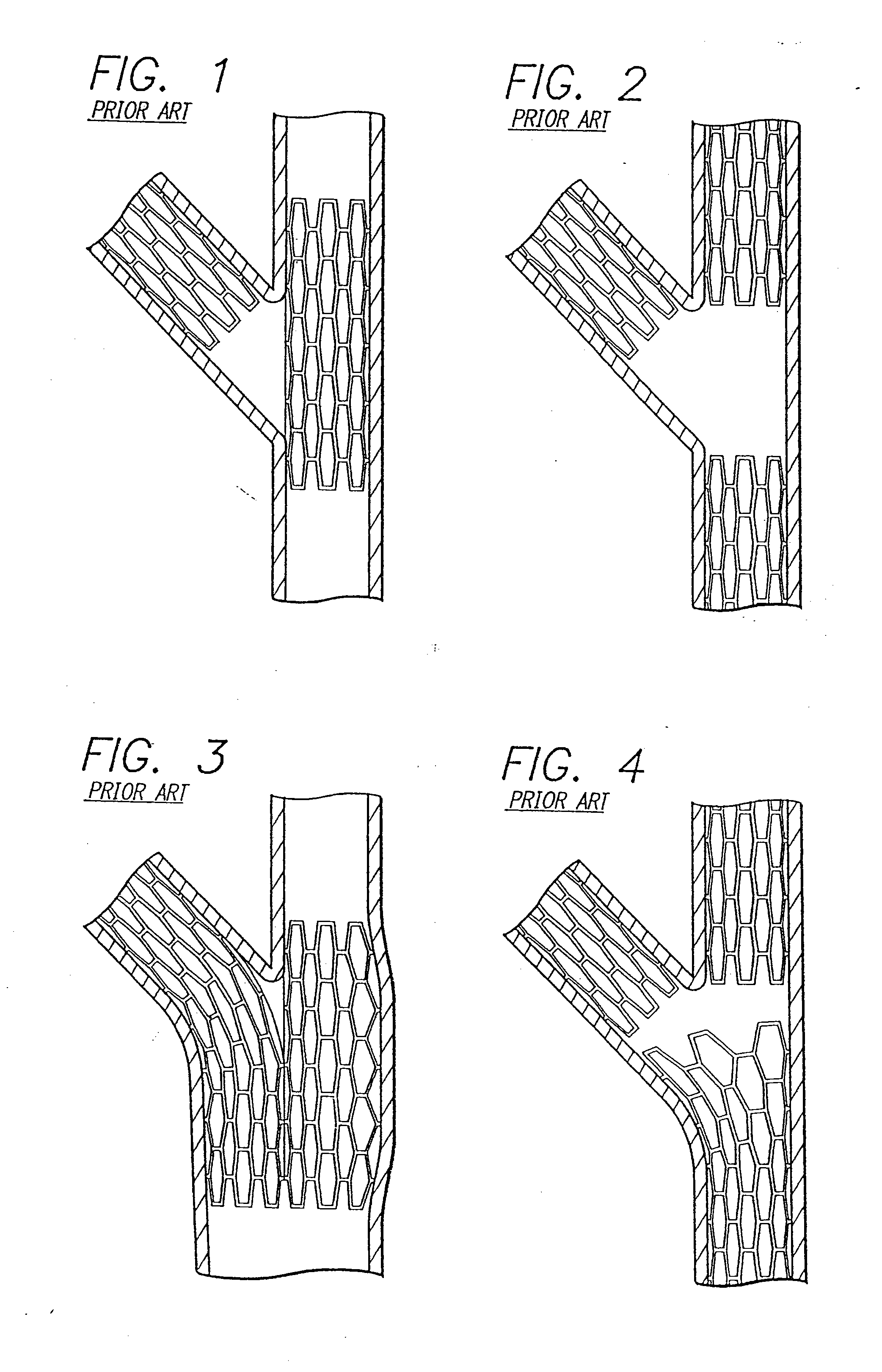 Stent and catheter assembly and method for treating bifurcations