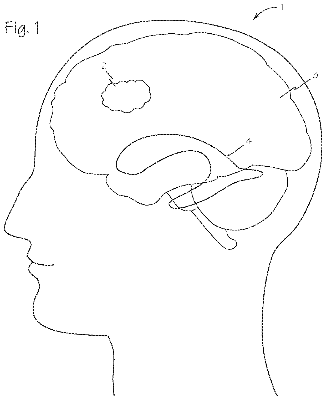 Methods and Devices for Color Detection to Localize the Blood Mass of an Intracerebral Hematoma