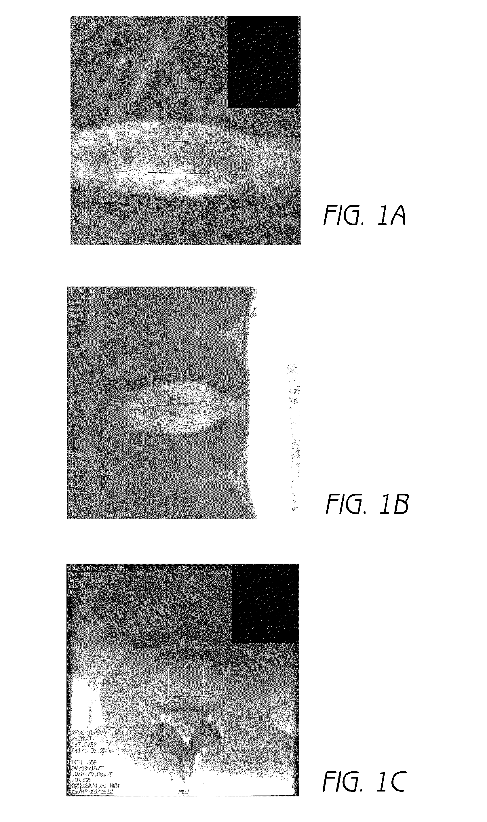 Mr spectroscopy system and method for diagnosing painful and non-painful intervertebral discs