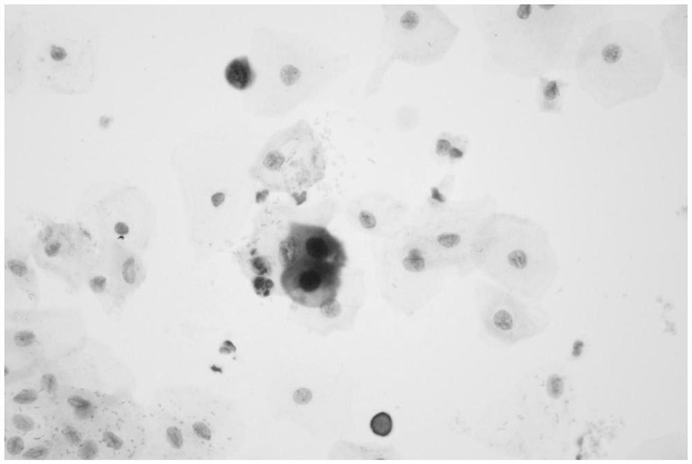 Immune cell chemical labeling chromogenic kit for auxiliary diagnosis of cervical cancer