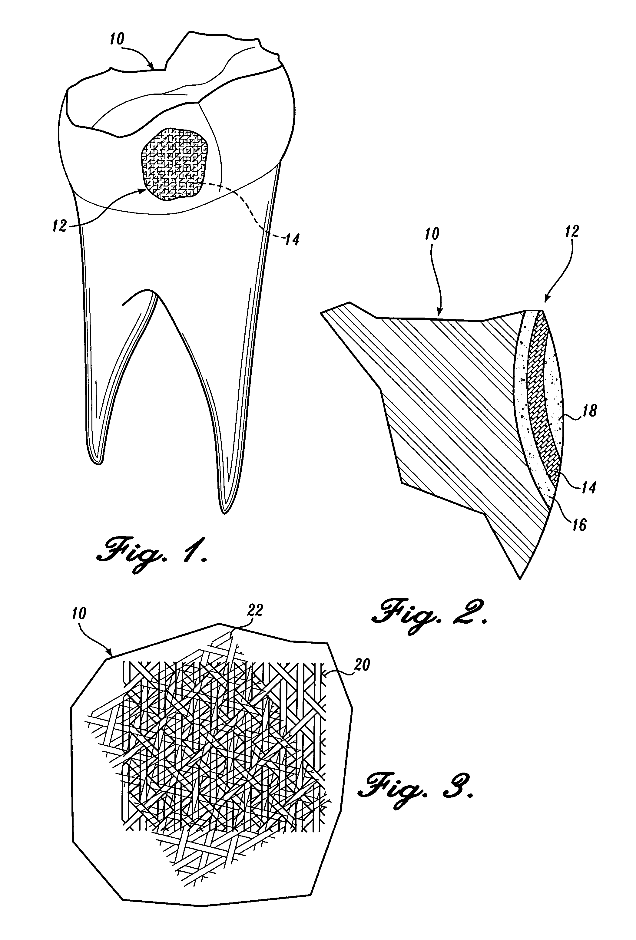 Triaxial weave for reinforcing dental resins