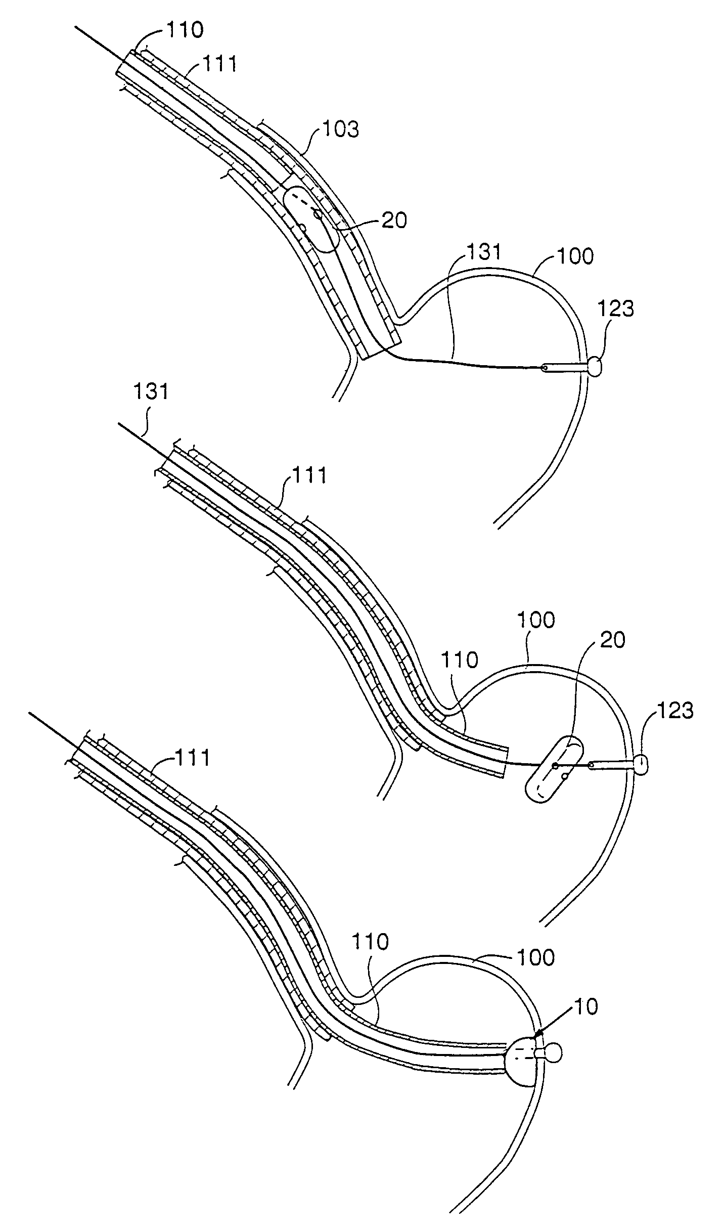 Gastric anchor and method