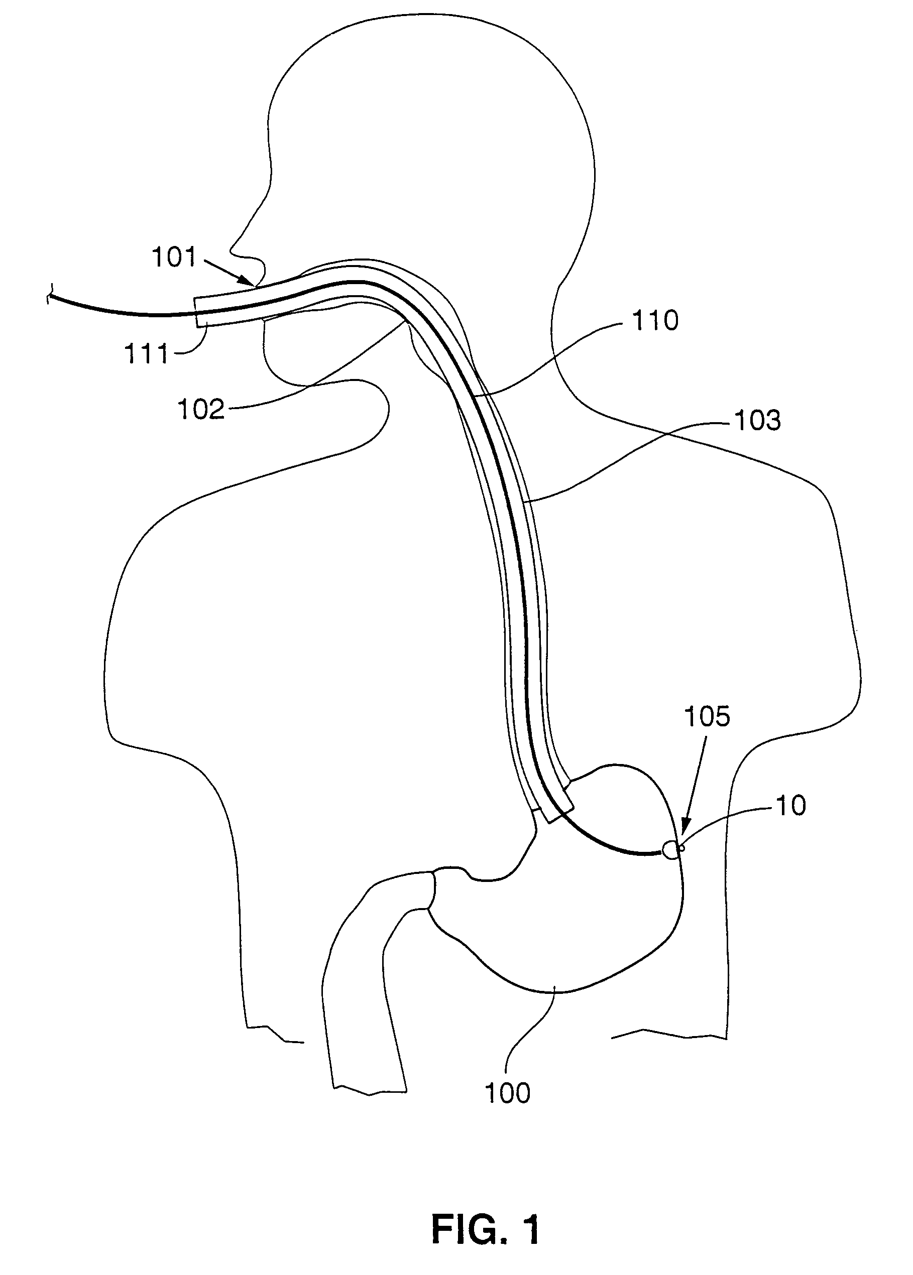 Gastric anchor and method