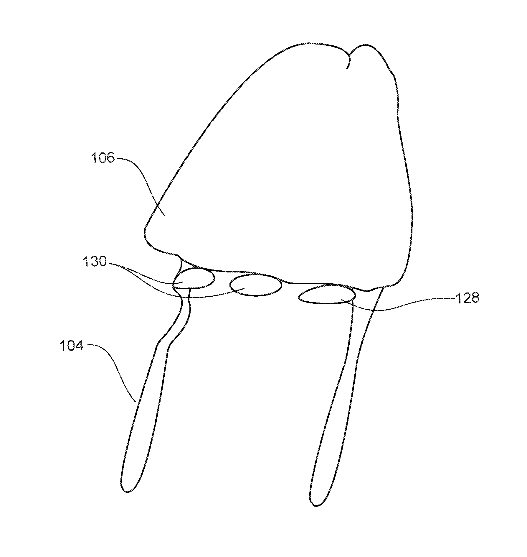 Minimally Invasive Method of Augmenting a Glans Penis with Intradermal Filler Material