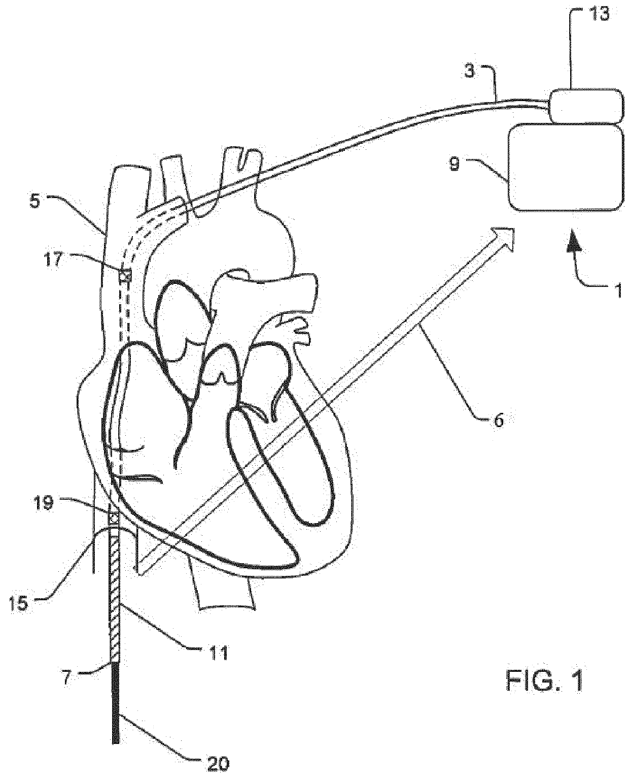 System and method for extra cardiac defibrillation