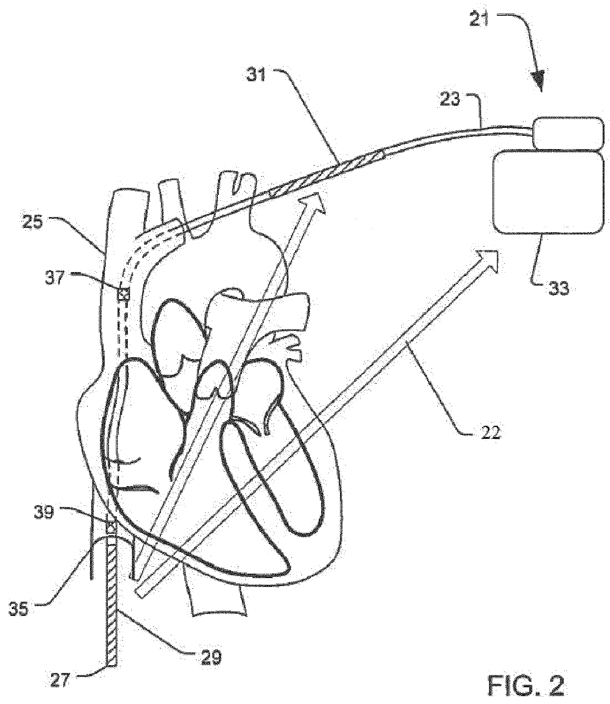 System and method for extra cardiac defibrillation