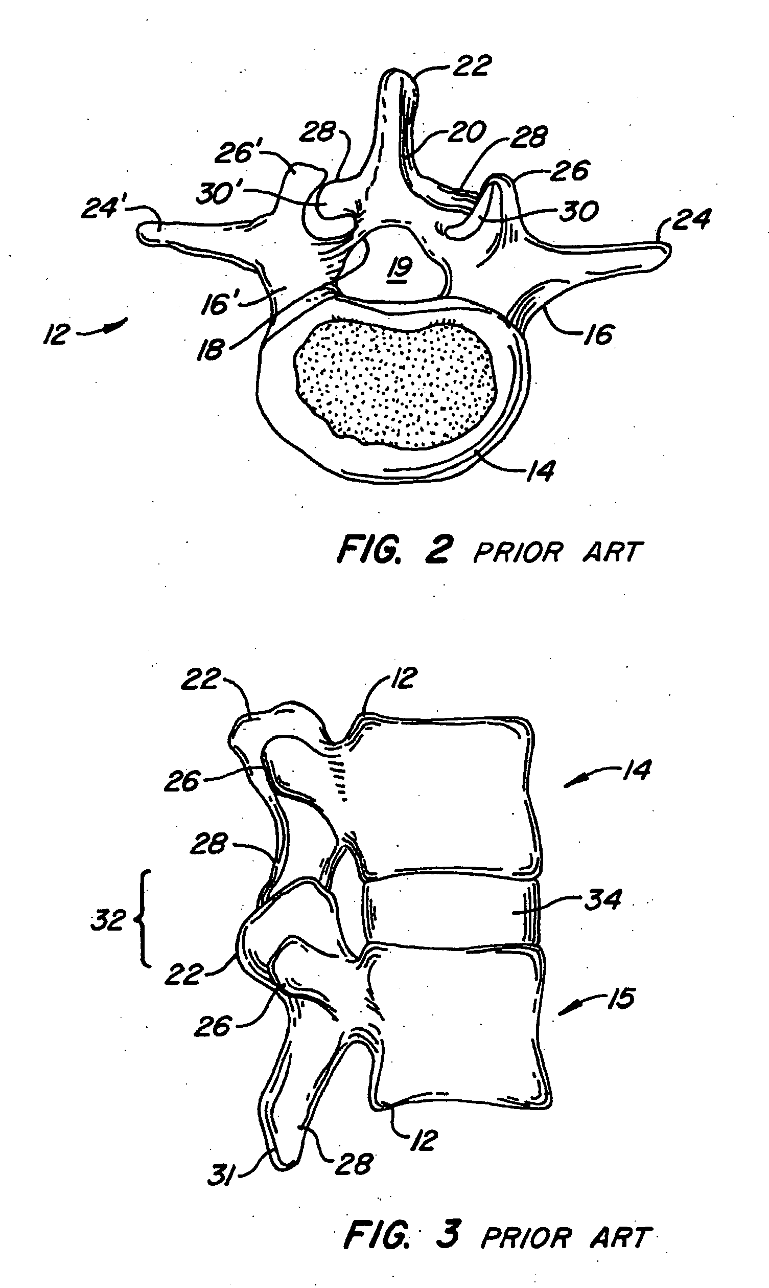 Implantable spinal device revision system