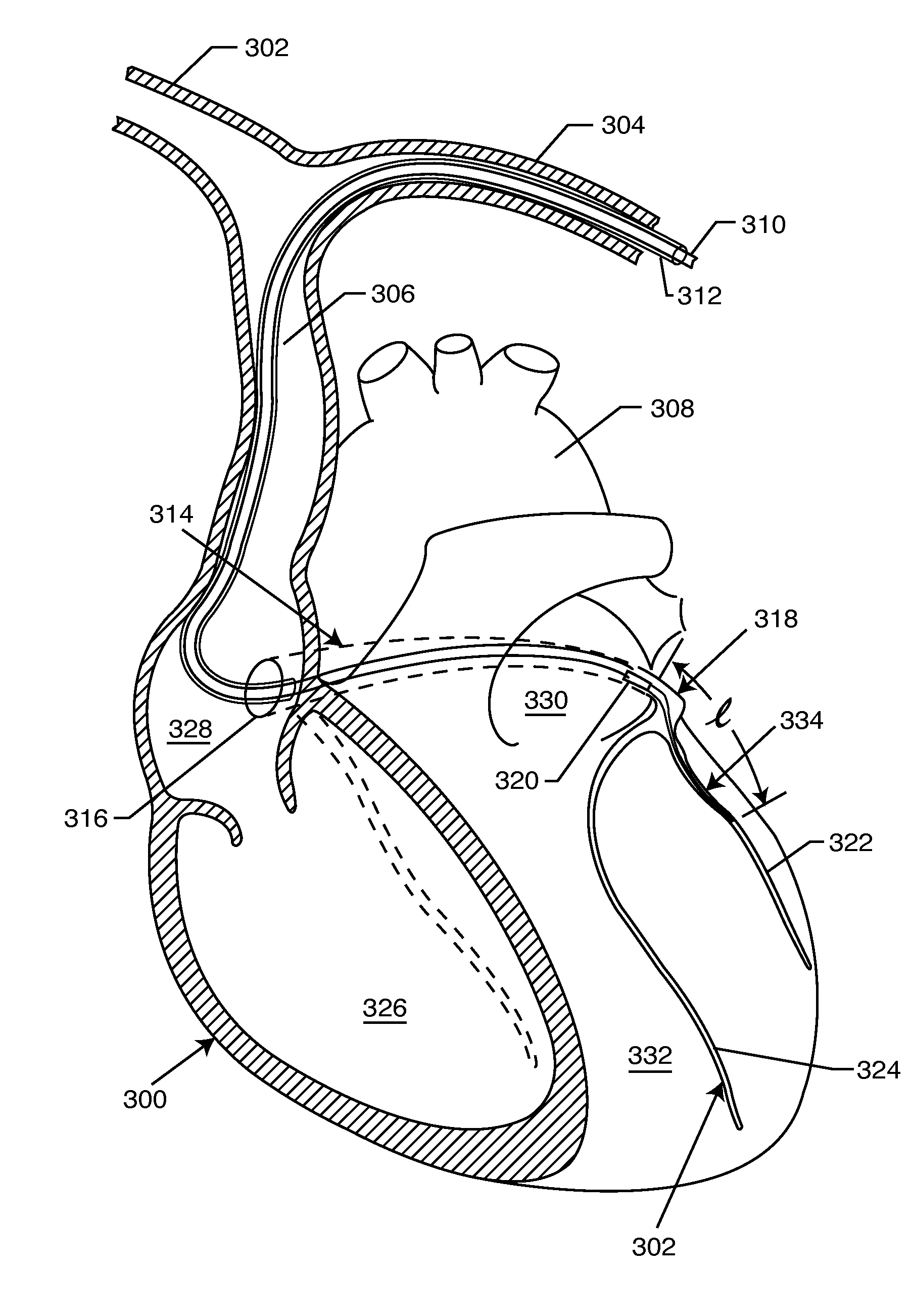 Electronic network components utilizing biocompatible conductive adhesives for direct body fluid exposure