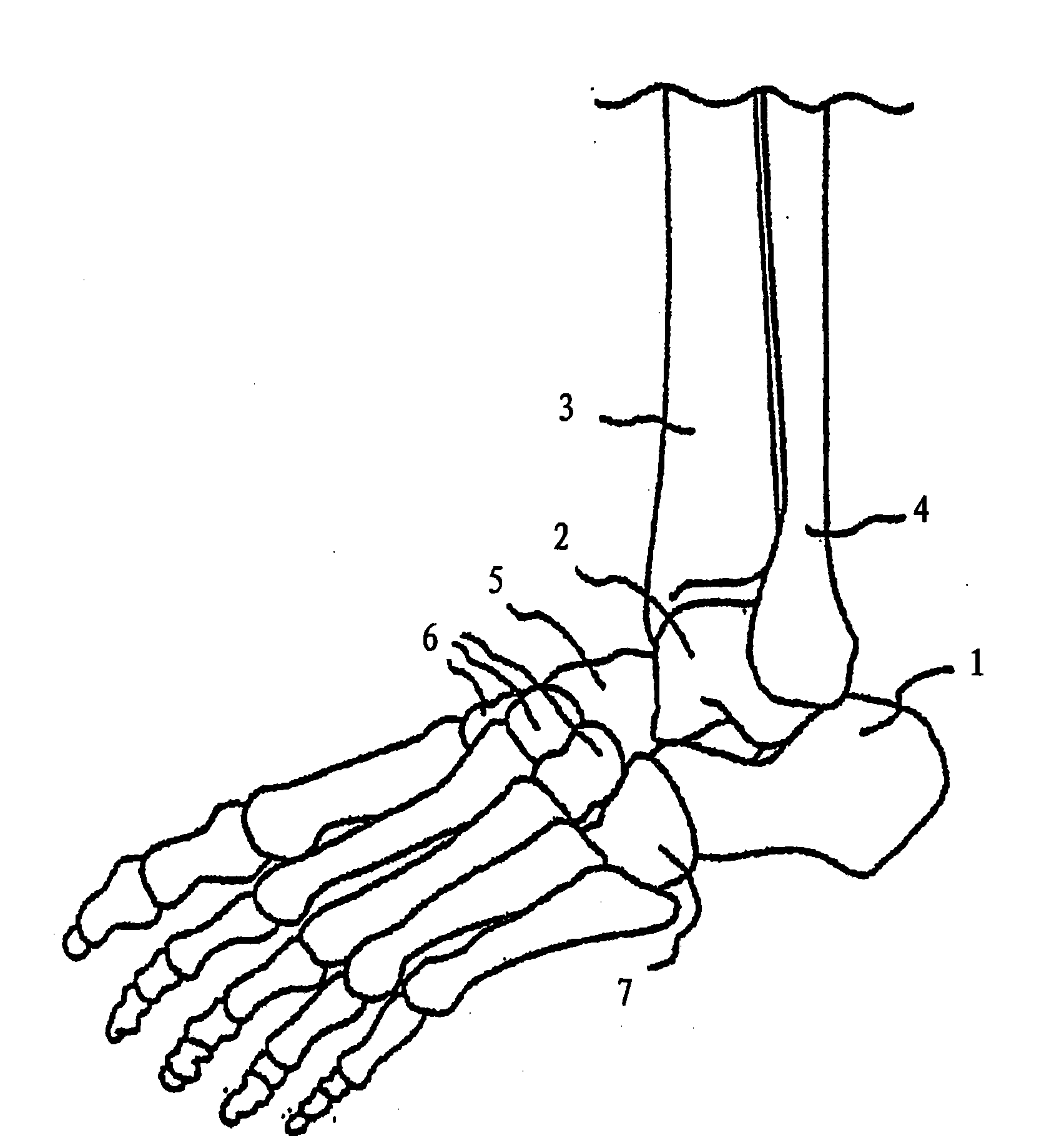 Bone nail for the heel