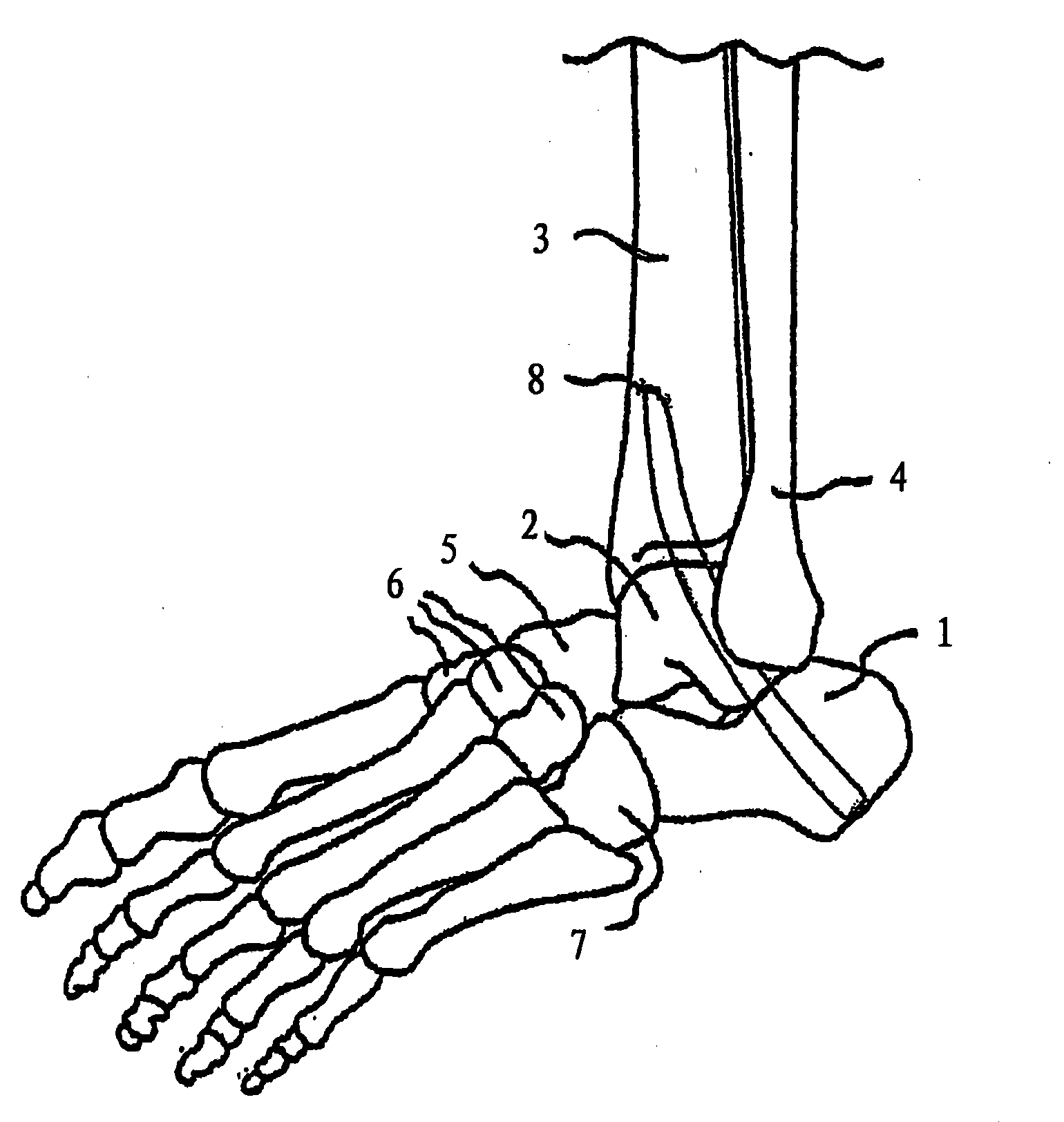 Bone nail for the heel