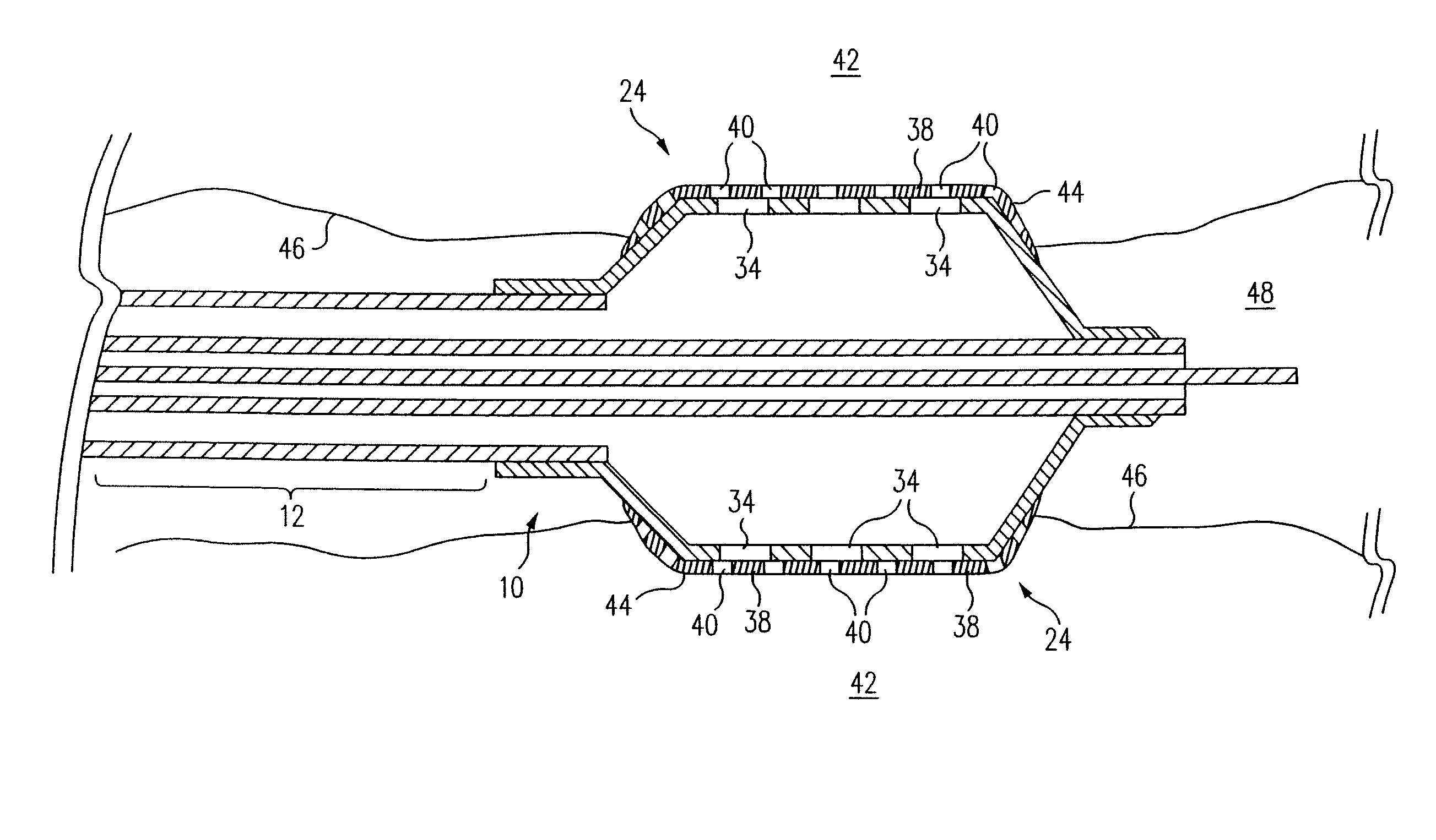 Balloon catheter for delivering therapeutic agents