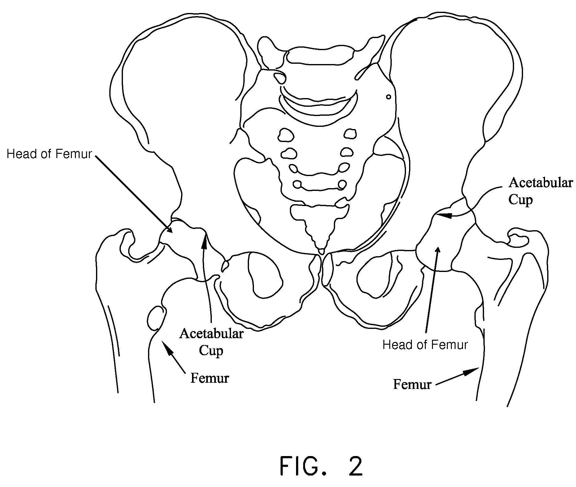 Method and apparatus for re-attaching the labrum to the acetabulum, including the provision and use of a novel suture anchor system