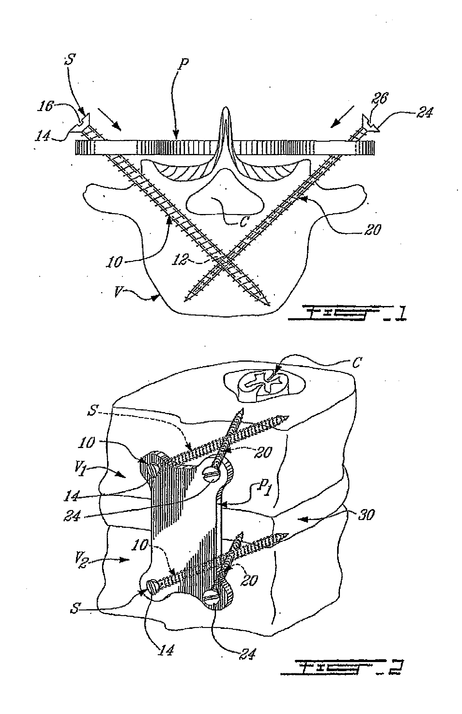 Anchoring System for Fixing Objects to Bones