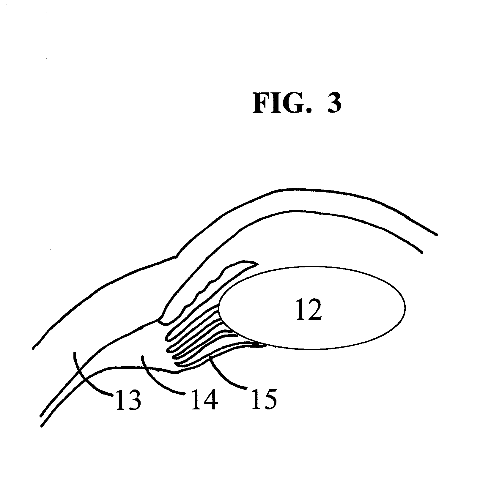 Methods and apparatus for presbyopia treatment using a scanning laser system