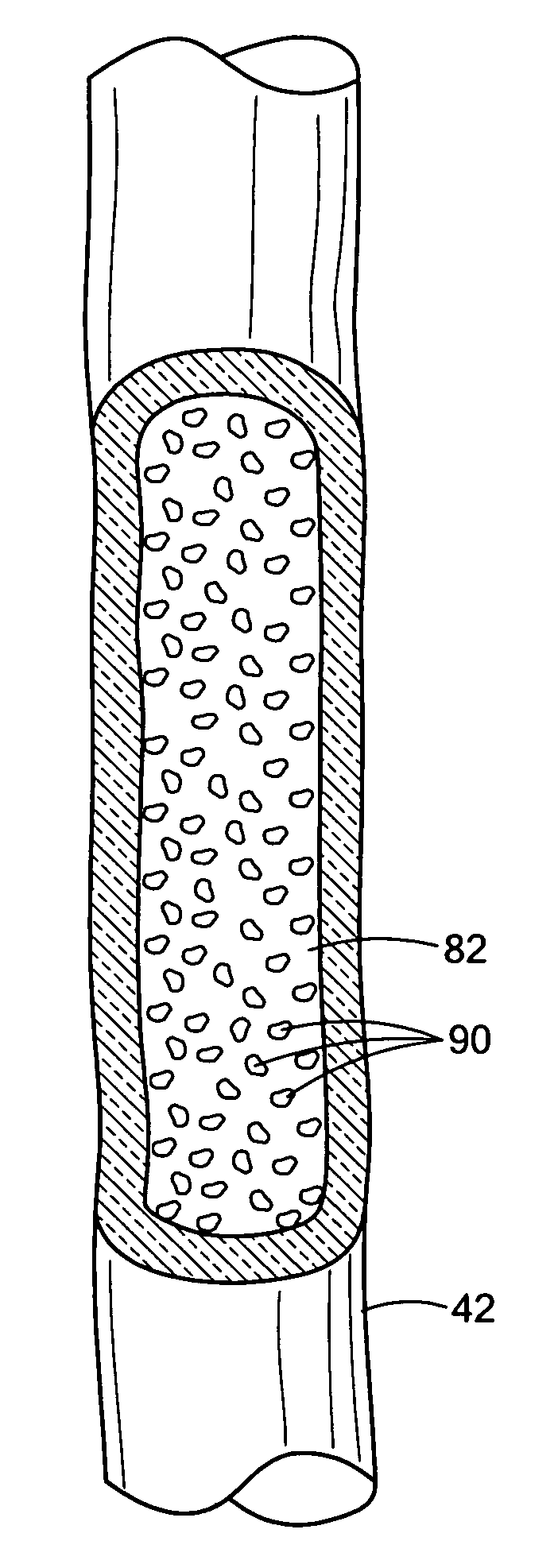 System for pretreating the lumen of a catheter
