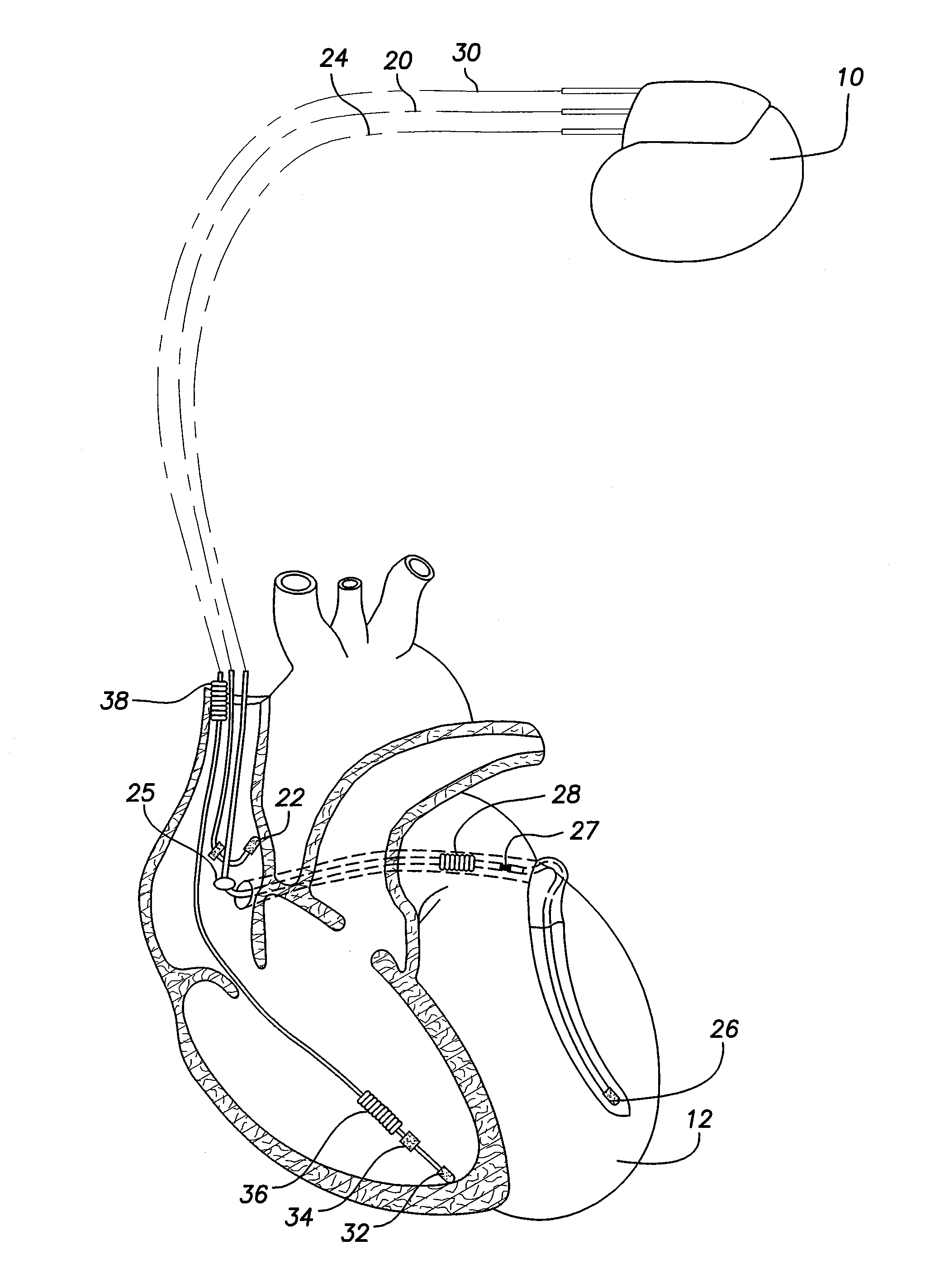 Method to stabilize ventricular rate during episodes of atrial fibrillation