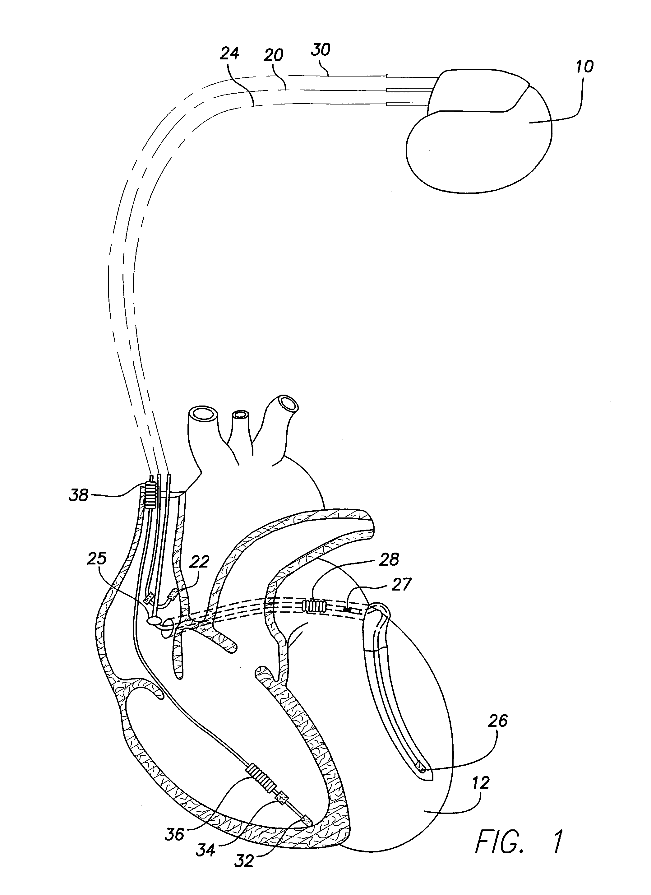 Method to stabilize ventricular rate during episodes of atrial fibrillation