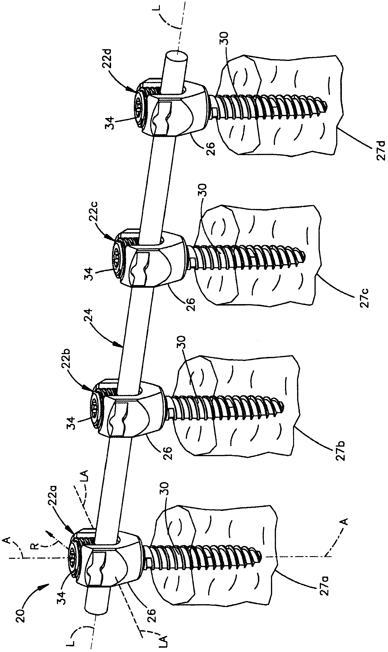 Revision connector for spinal constructs