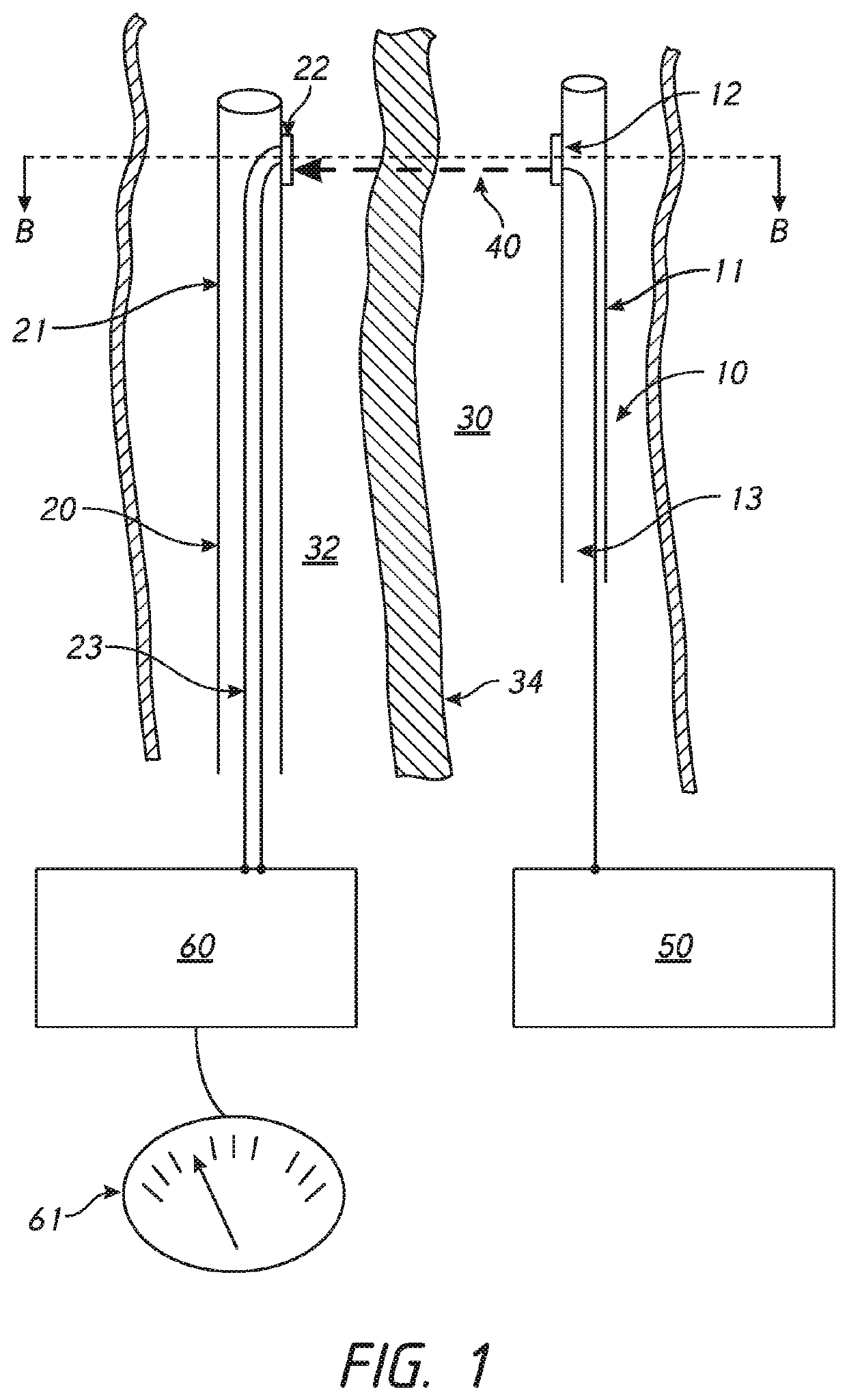 Methods for routing a guidewire from a first vessel and through a second vessel in lower extremity vasculature