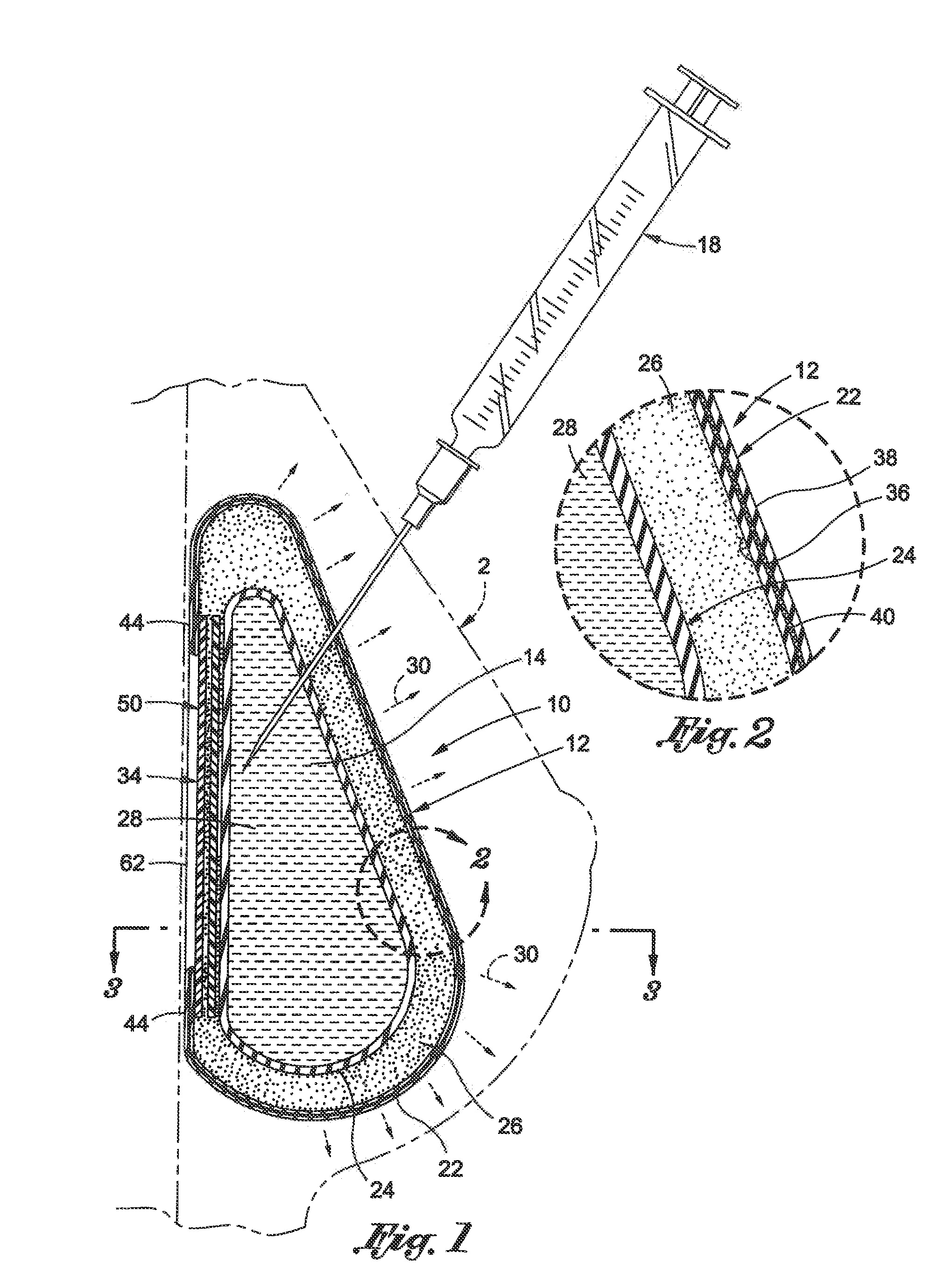Inflatable prostheses and methods of making same
