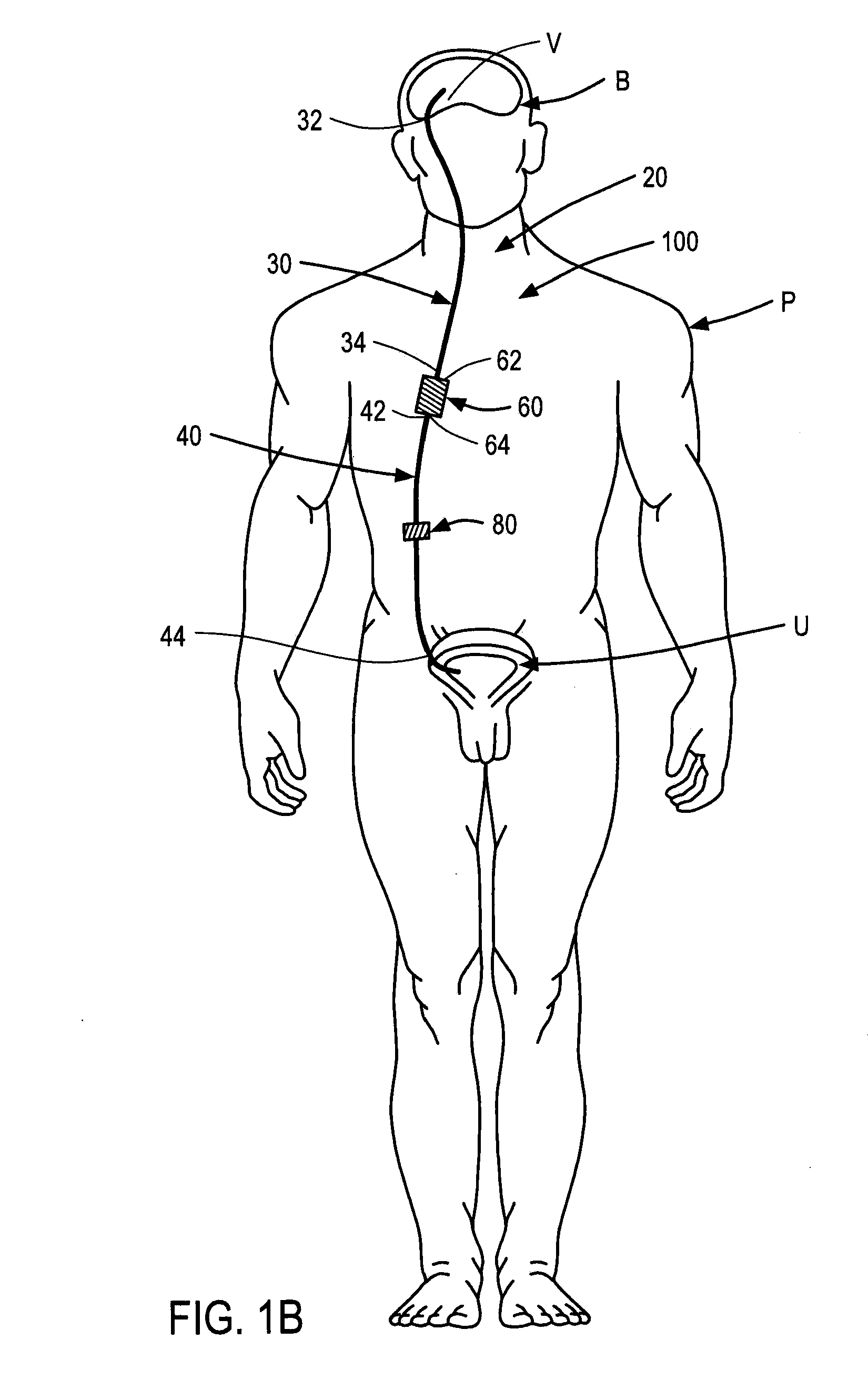 Systems and methods for moving and circulating fluid to treat alzheimer's disease