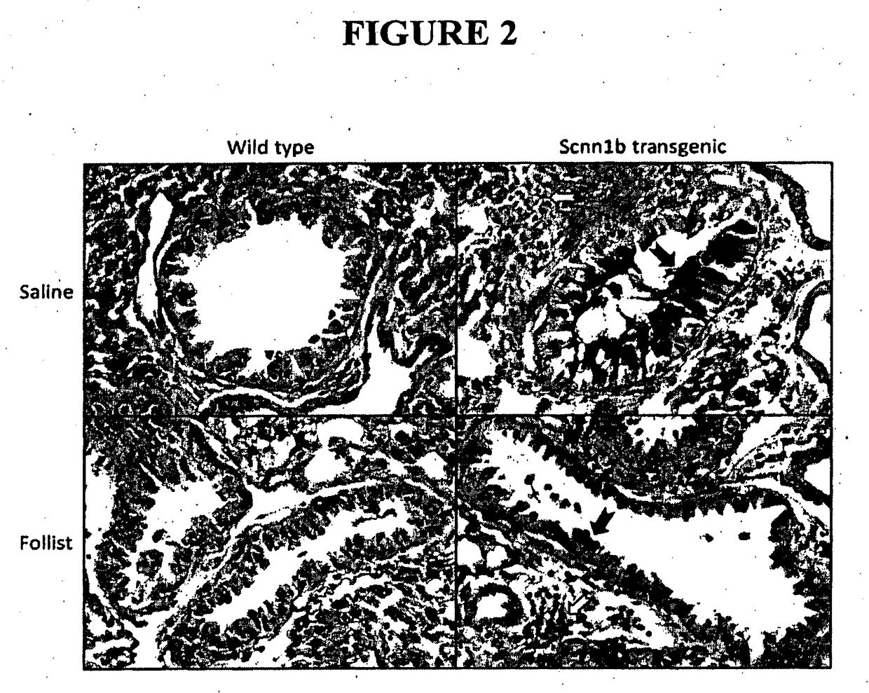 Method of treating mucus hypersecretion