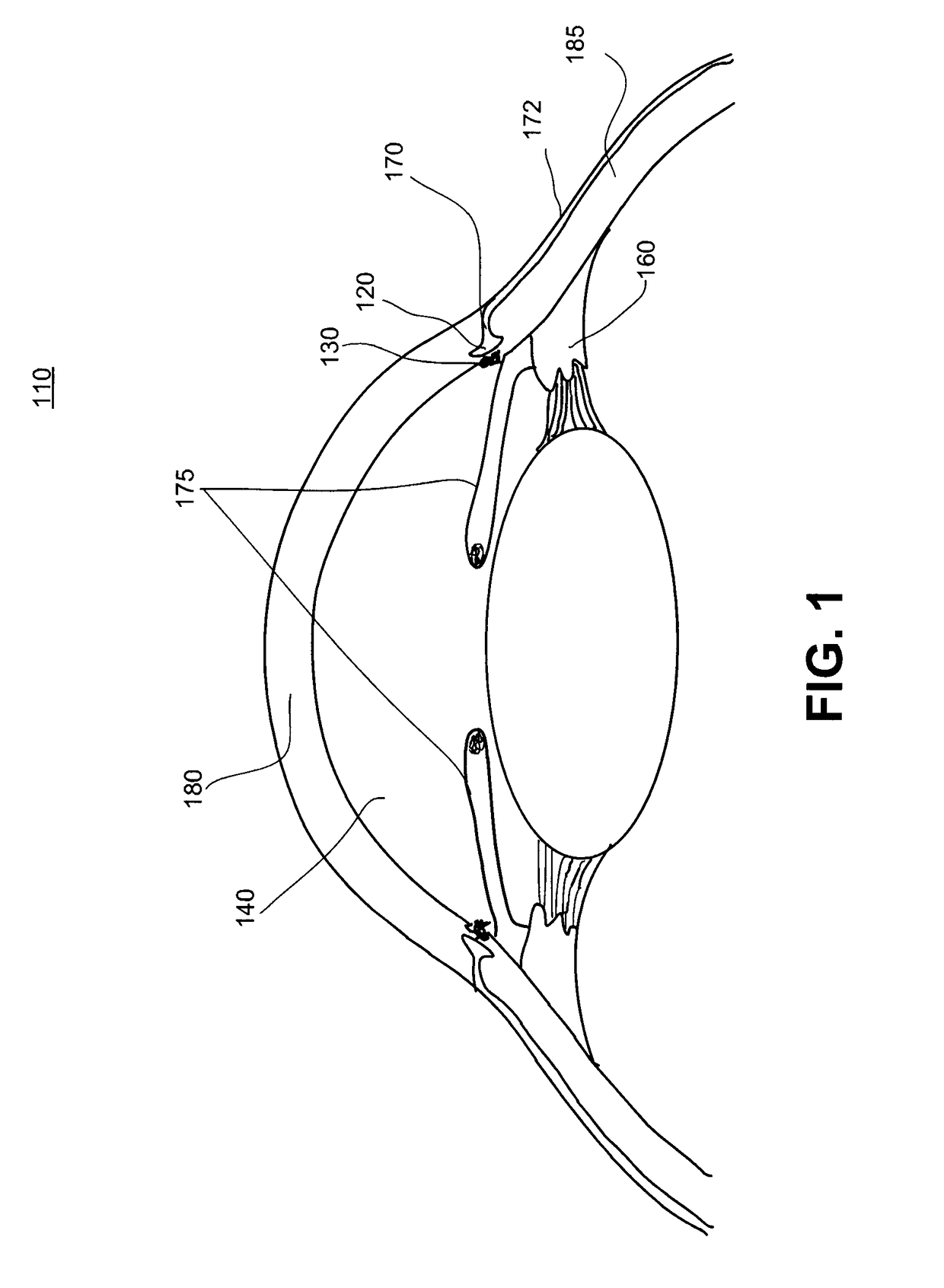 Method And System For Laser Automated Trabecular Excision