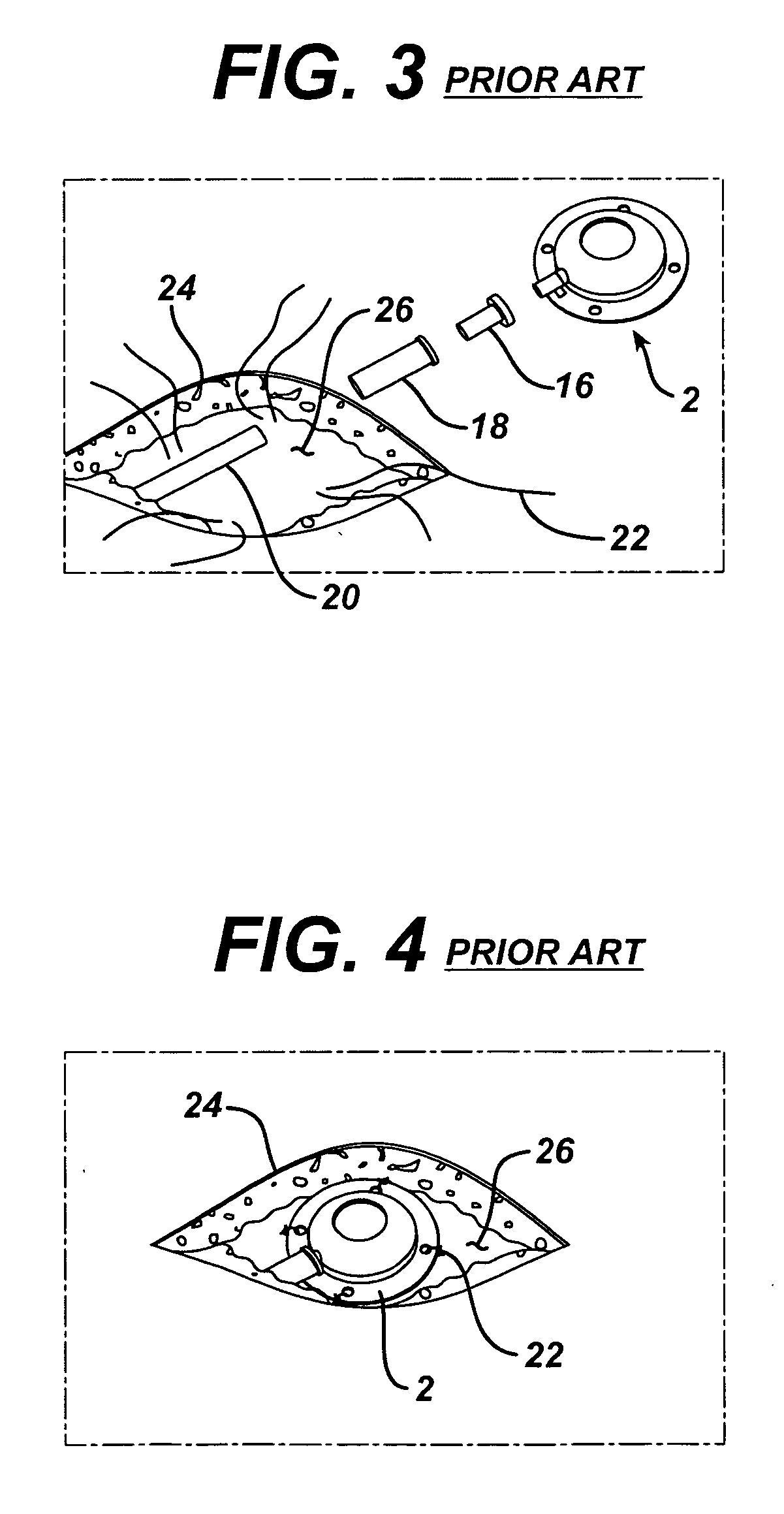 Method of implanting a subcutaneous injection port having stabilizing elements