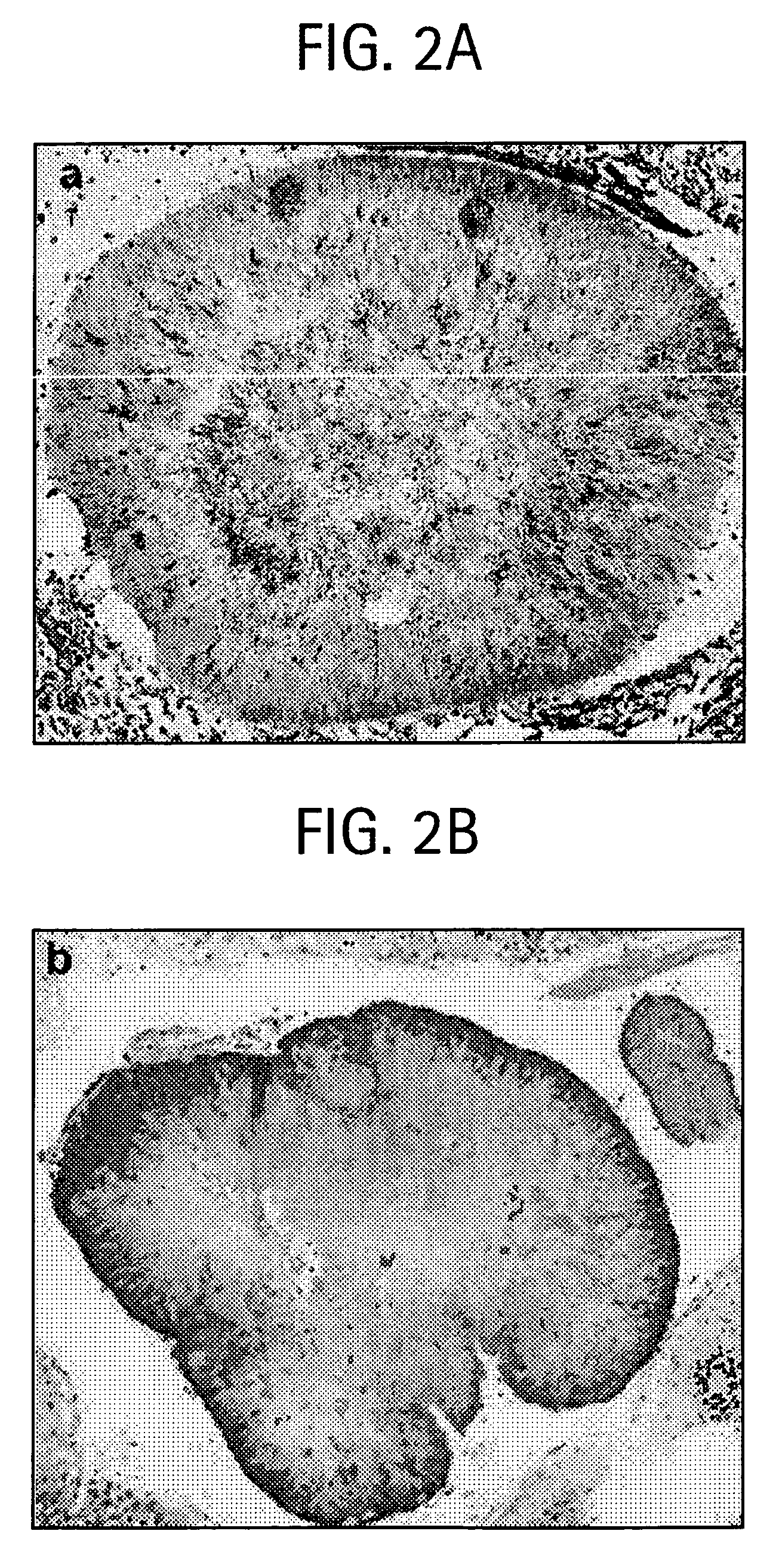 Methods for diagnosing and treating chronic tonsillitis