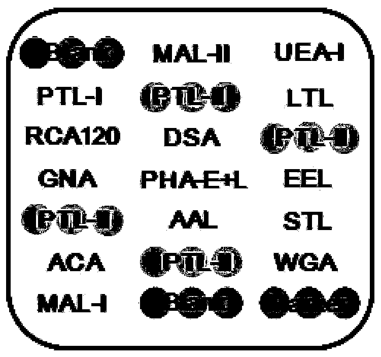 Application of specific lectin combination in constructing test tool for identifying liver fibrosis (HF) based on saliva glycoprotein sugar chain