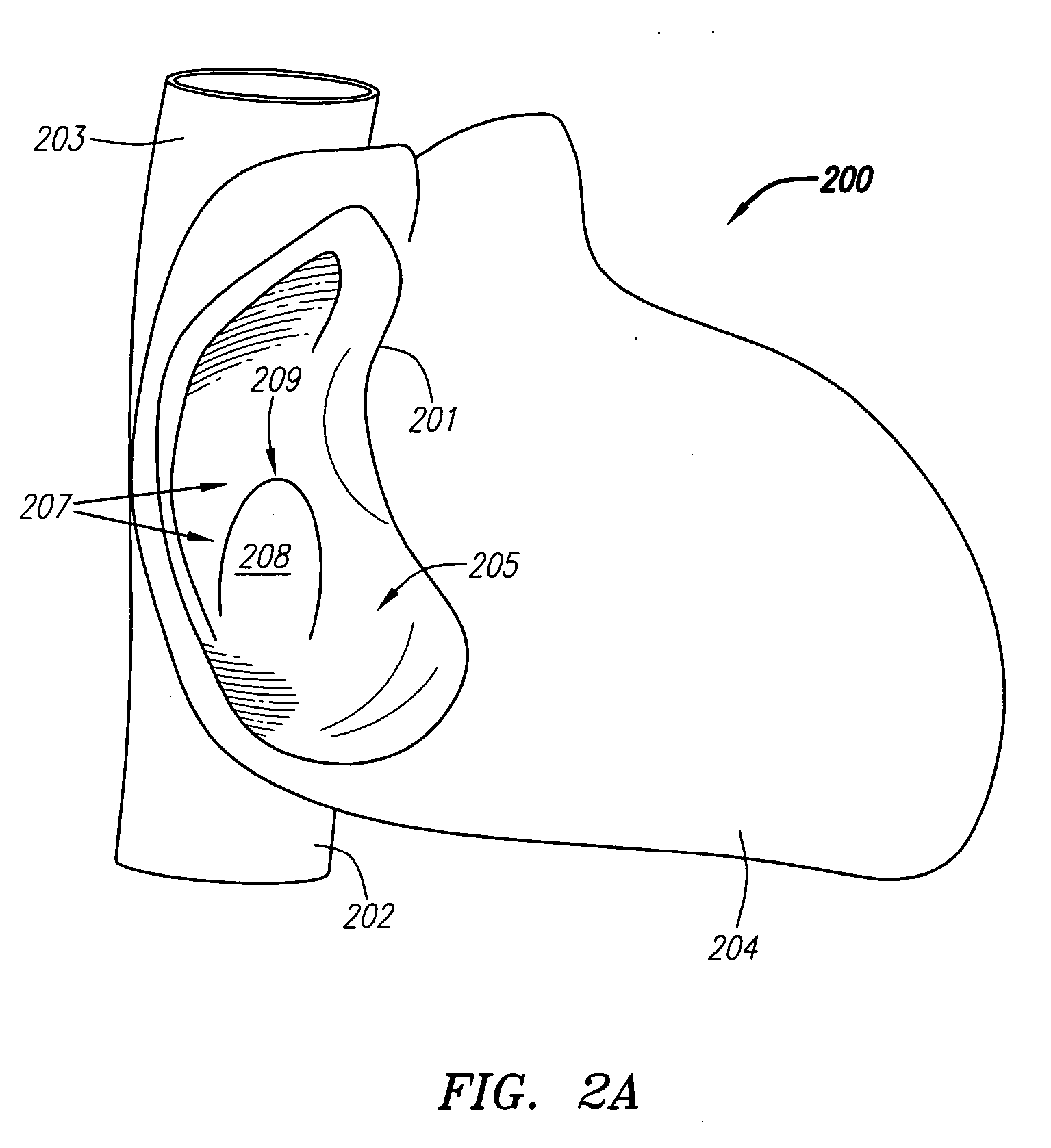 Systems and methods for treating septal defects